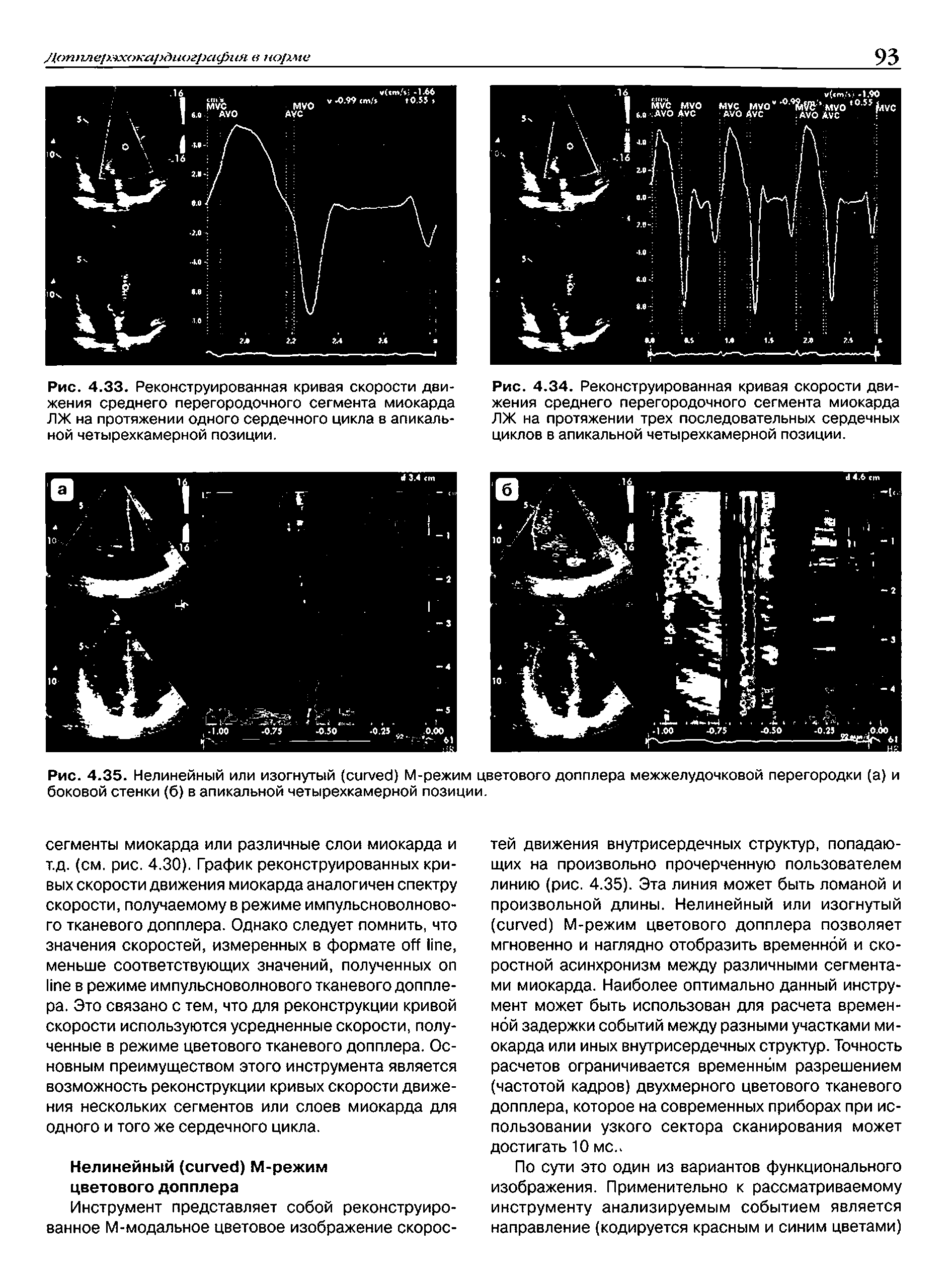 Рис. 4.35. Нелинейный или изогнутый ( ) М-режим цветового допплера межжелудочковой перегородки (а) и боковой стенки (б) в апикальной четырехкамерной позиции.