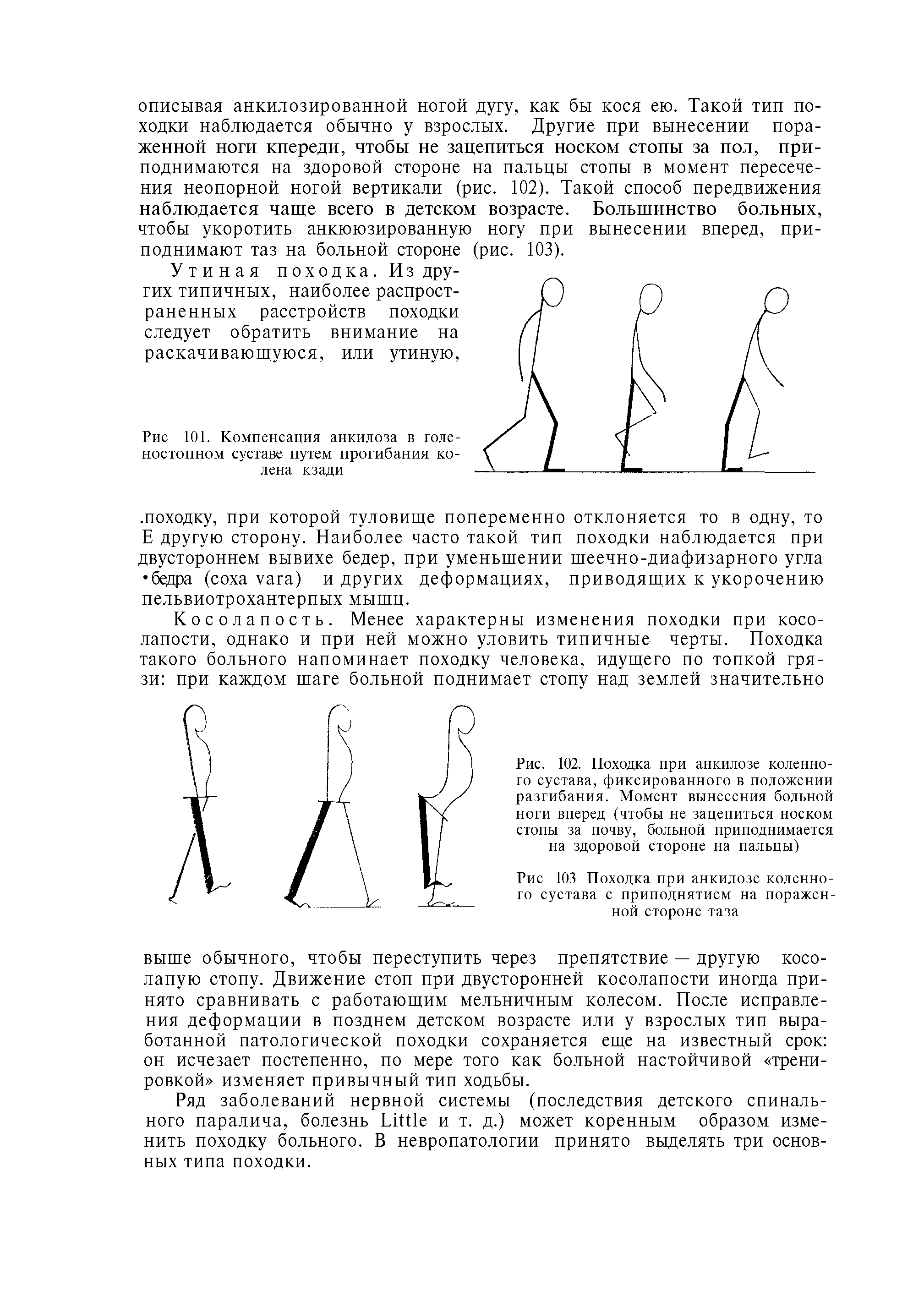 Рис. 102. Походка при анкилозе коленного сустава, фиксированного в положении разгибания. Момент вынесения больной ноги вперед (чтобы не зацепиться носком стопы за почву, больной приподнимается на здоровой стороне на пальцы)...