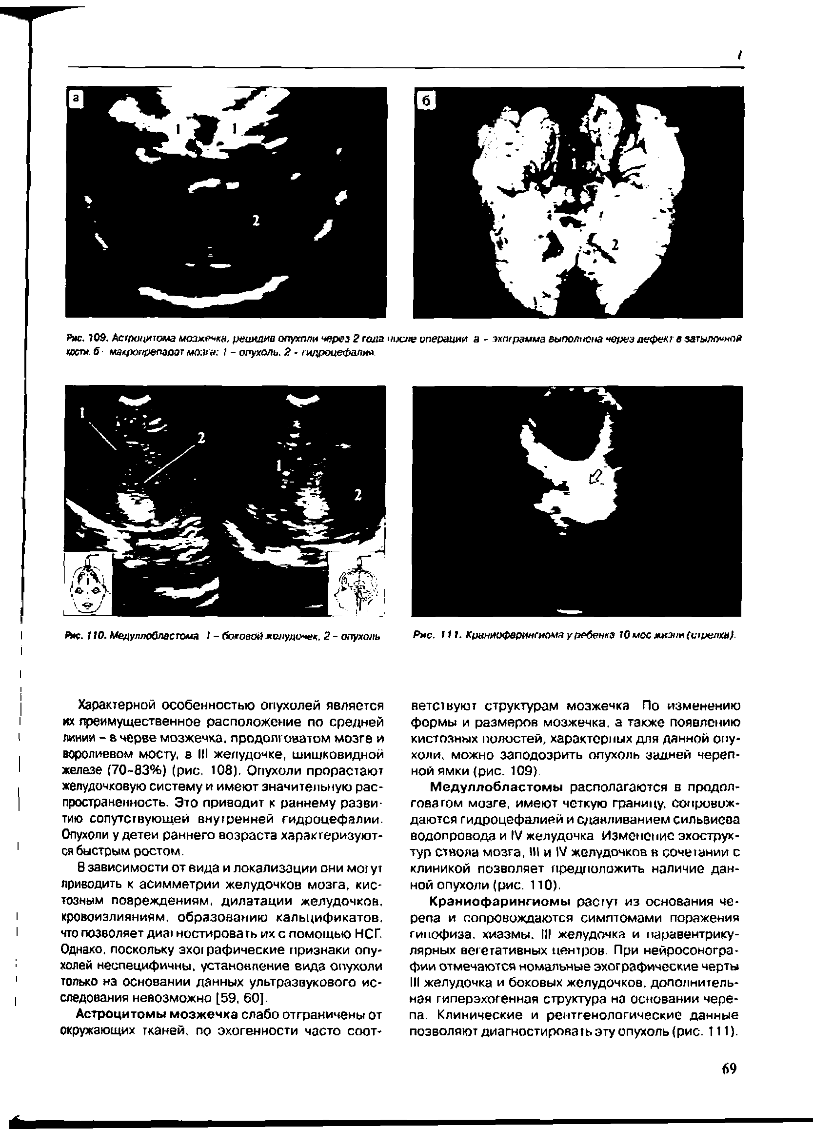 Рис. 109. Астроцитома мозжечка. рецидив опухоли через 2 тола числе операции а - зхпграмма выполнена через дефект в затылочной кос . <5 макропрепарэт мане I - опухоль. 2 - гидроцефалии...