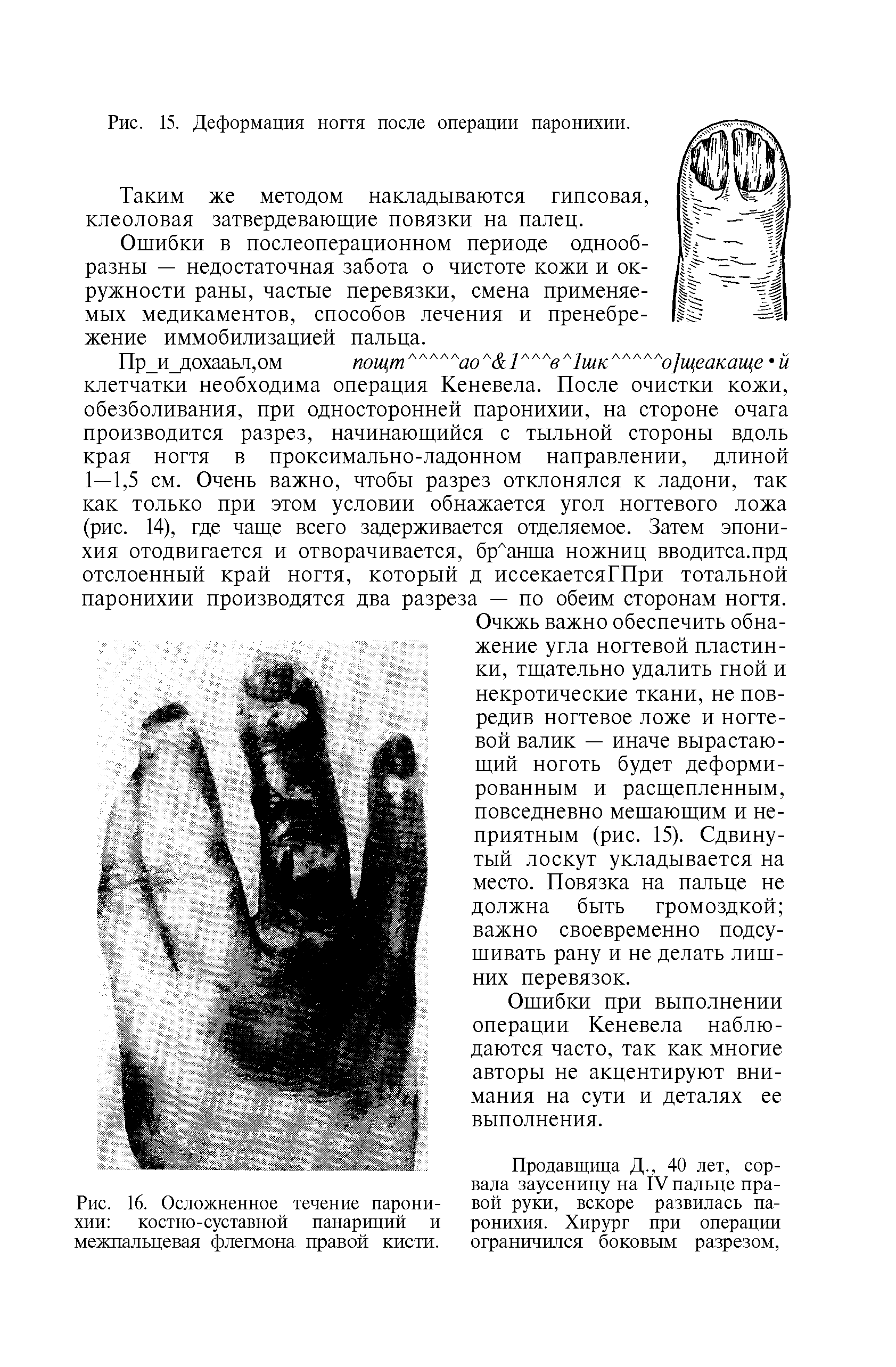 Рис. 16. Осложненное течение паронихии костно-суставной панариций и...