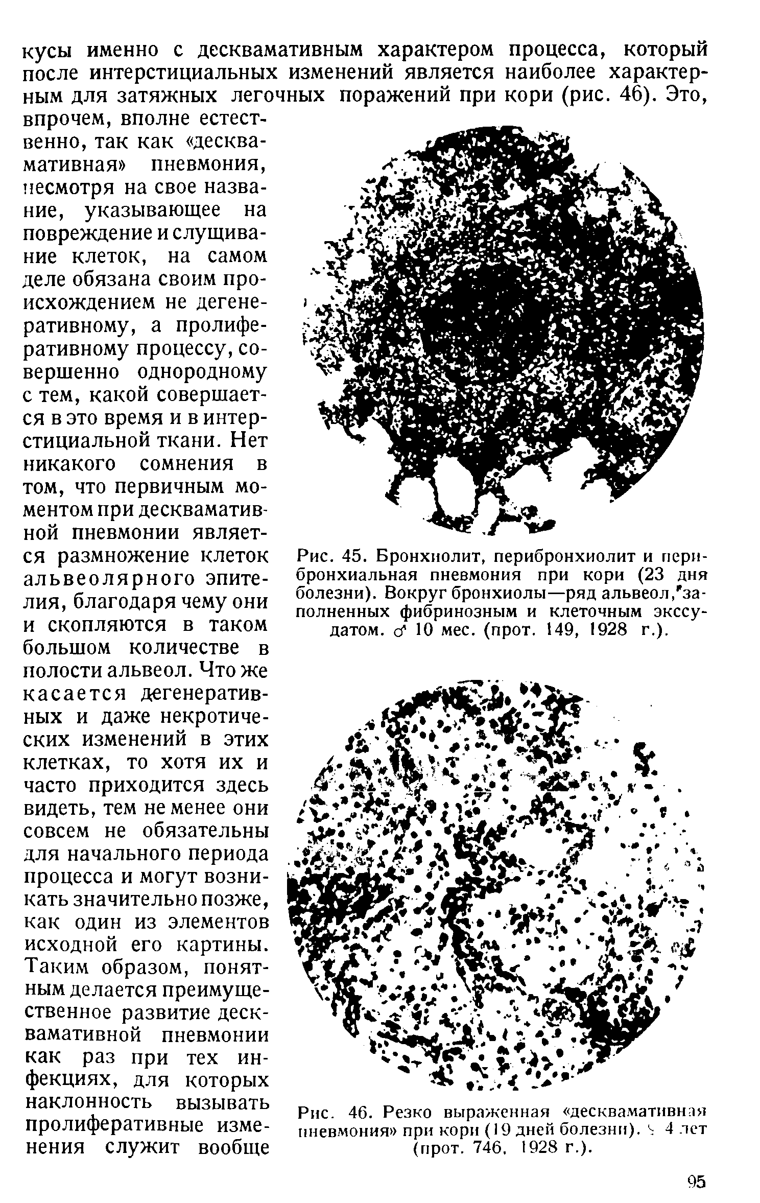 Рис. 45. Бронхиолит, перибронхиолит и пери-бронхиальная пневмония при кори (23 дня болезни). Вокруг бронхиолы—ряд альвеол, заполненных фибринозным и клеточным экссудатом. о1 10 мес. (прот. 149, 1928 г.).