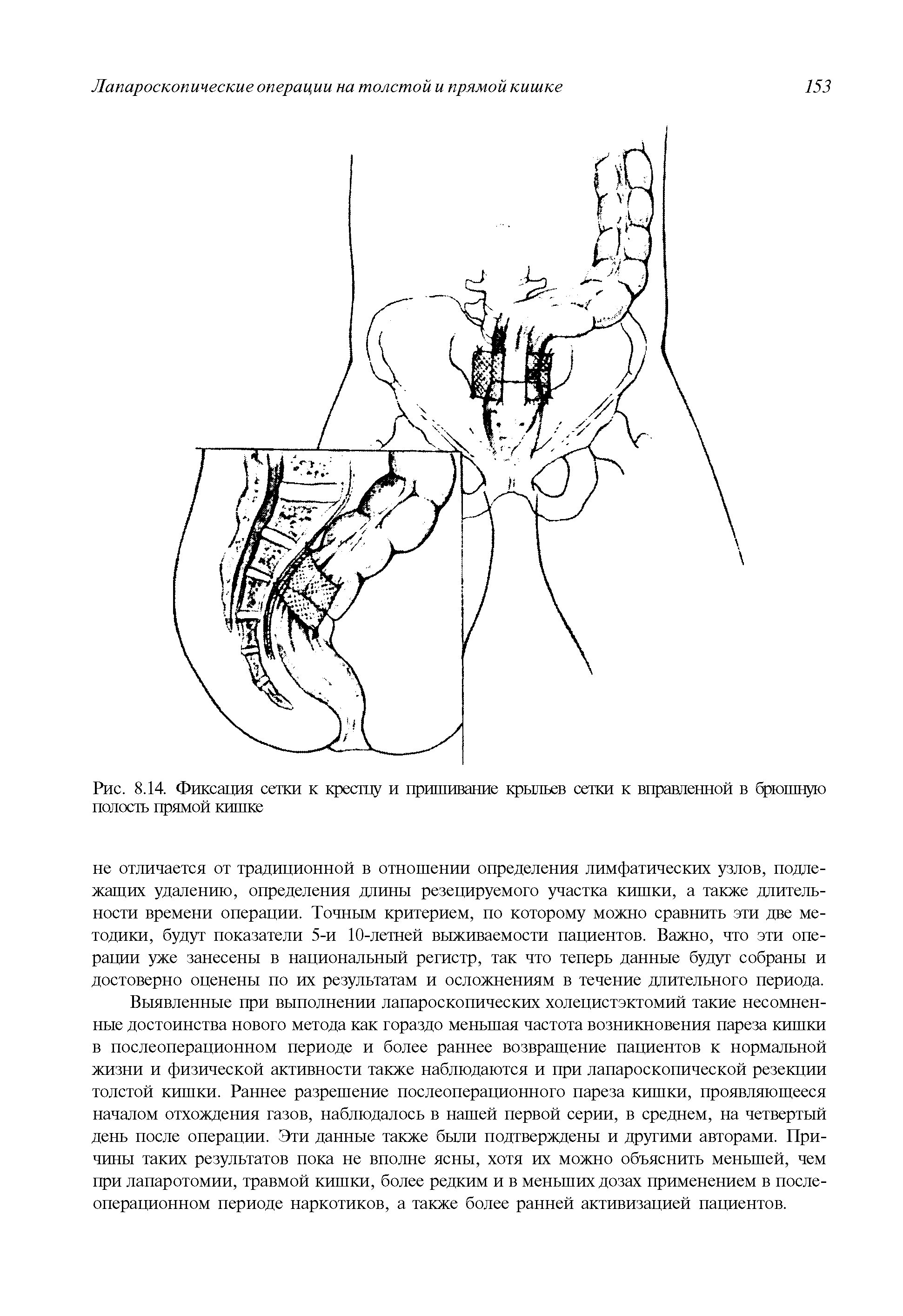 Рис. 8.14. Фиксация сетки к кресту и пришивание крыльев сетки к вправленной в брюшную полость прямой кишке...