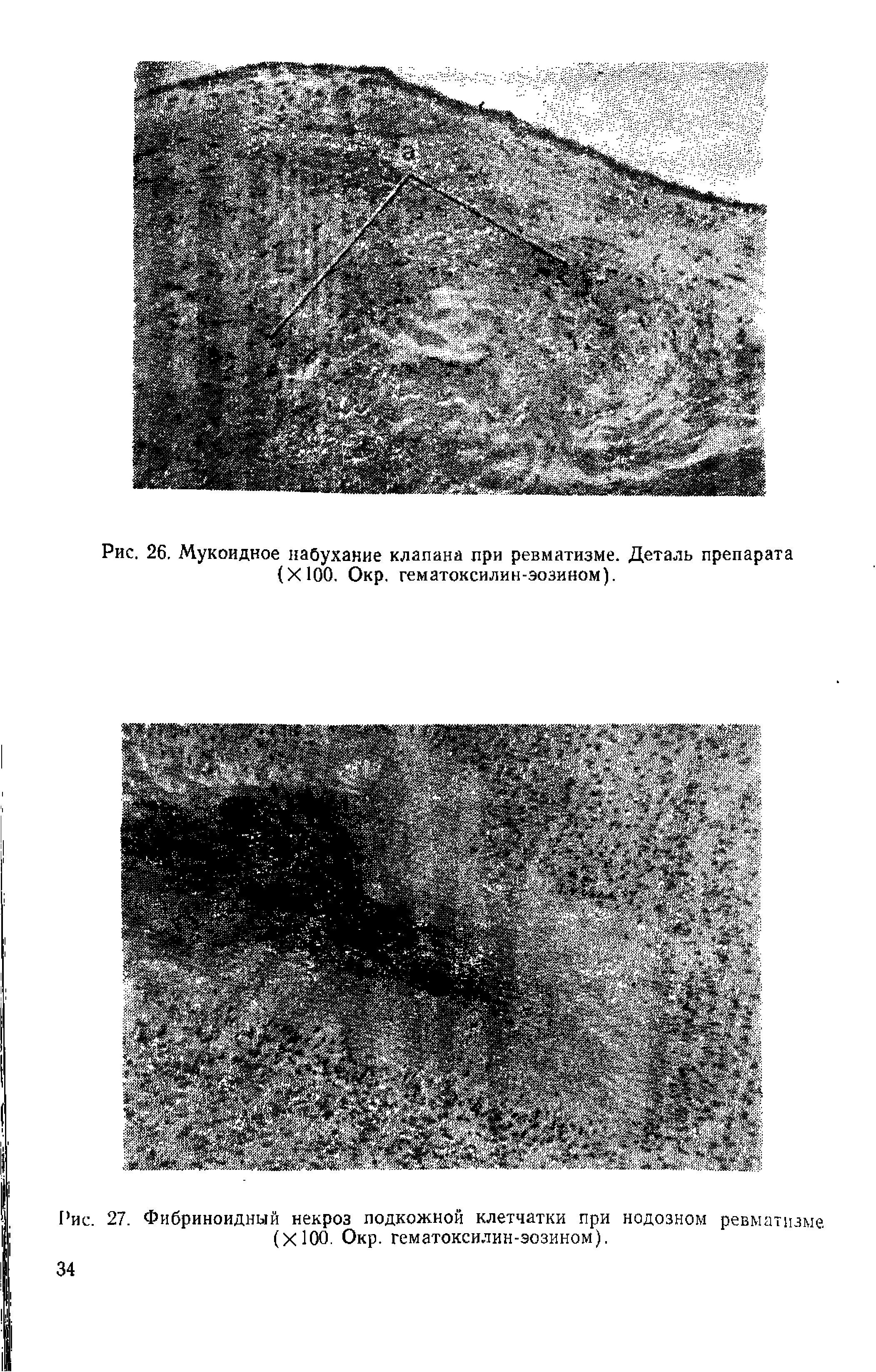 Рис. 27. Фибриноидный некроз подкожной клетчатки при нодозном ревматизме. (X100. Окр. гематоксилин-эозином).