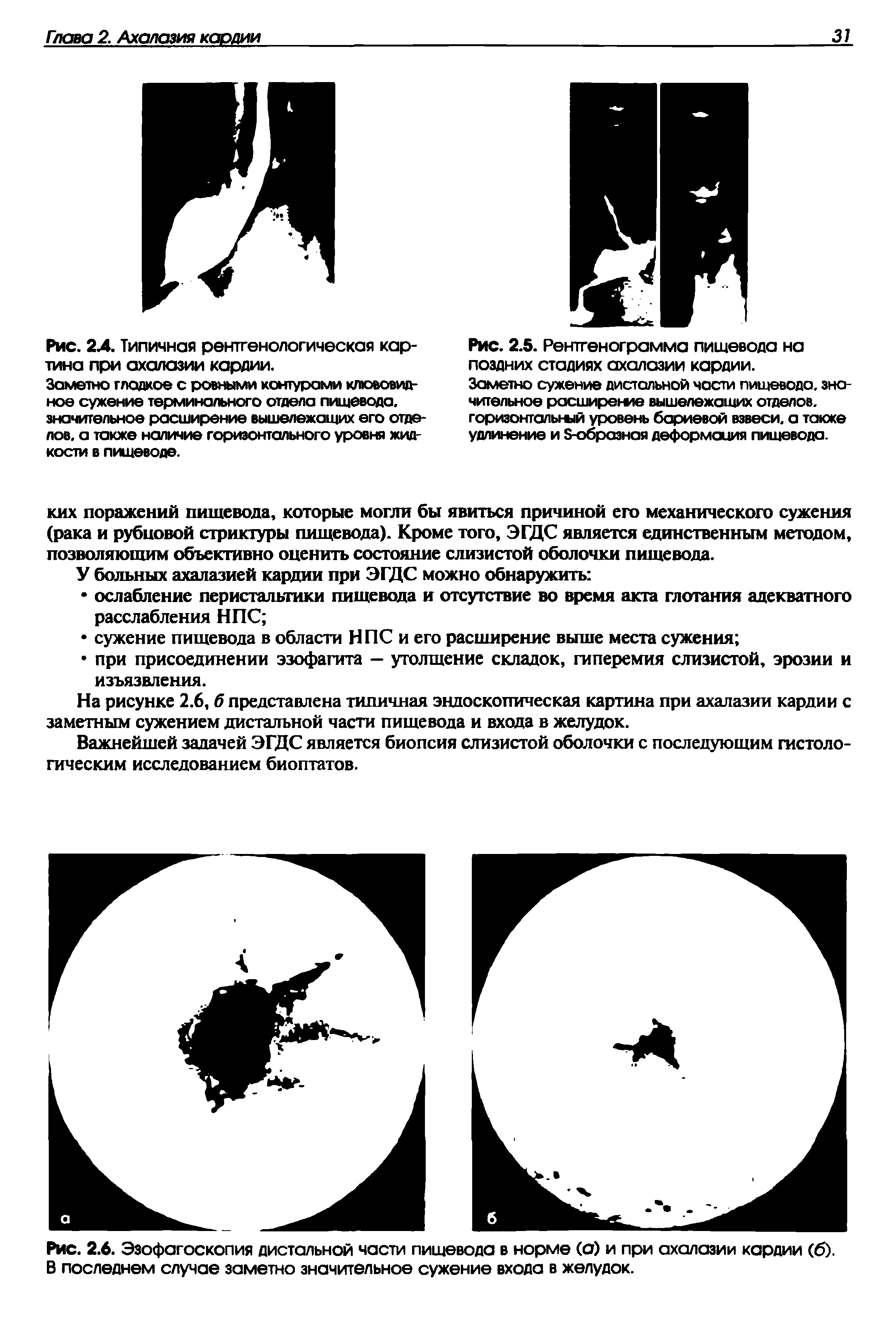 Рис. 2.6. Эзофагоскопия дистальной части пищевода в норме (а) и при ахалазии кардии (б). В последнем случае заметно значительное сужение входа в желудок.