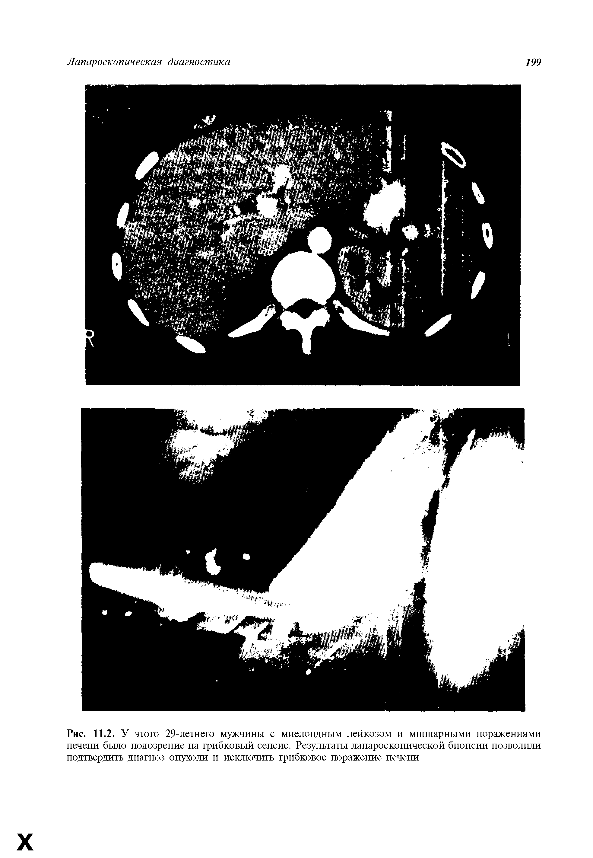 Рис. 11.2. У этого 29-летнего мужчины с миелоидным лейкозом и мшшарными поражениями печени было подозрение на грибковый сепсис. Результаты лапароскопической биопсии позволили подтвердить диагноз опухоли и исключить грибковое поражение печени...