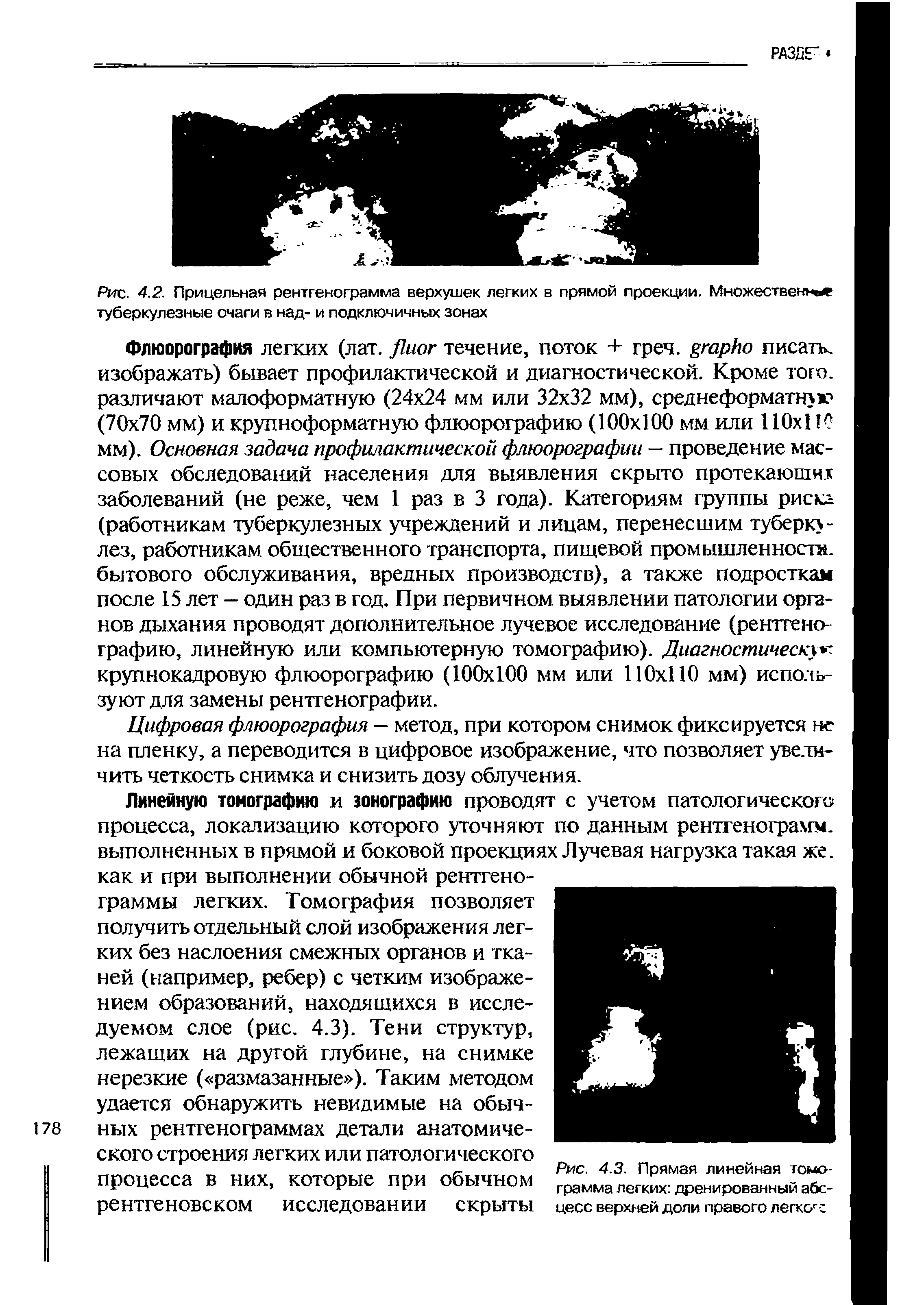 Рис. 4.3. Прямая линейная томограмма легких дренированный абсцесс верхней доли правого легкогс...