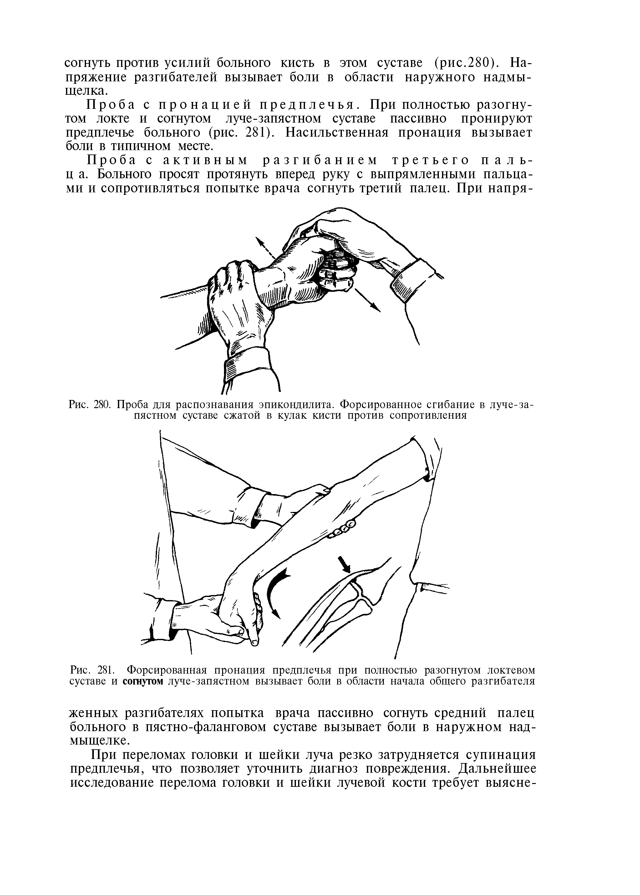 Рис. 281. Форсированная пронация предплечья при полностью разогнутом локтевом суставе и согнутом луче-запястном вызывает боли в области начала общего разгибателя...
