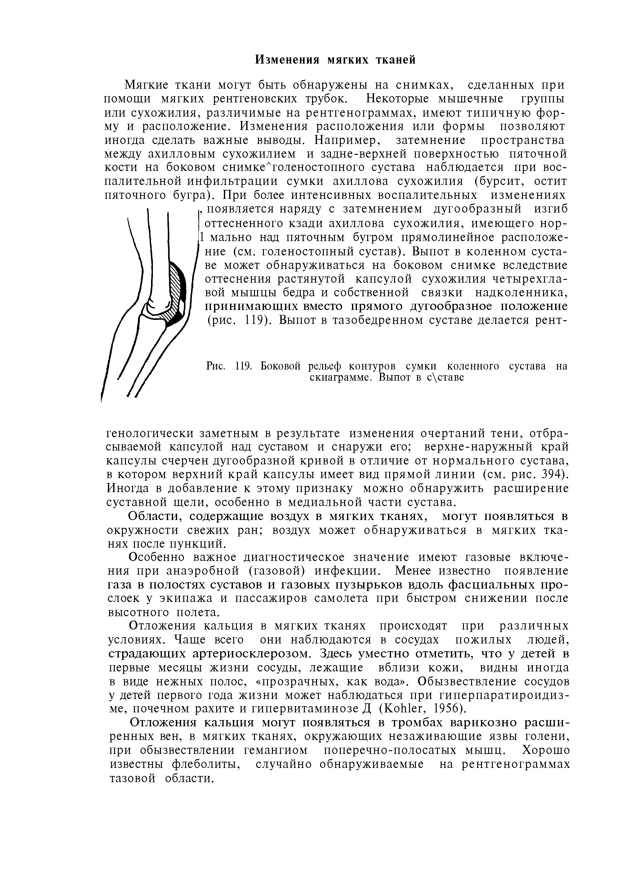 Рис. 119. Боковой рельеф контуров сумки коленного сустава на скиаграмме. Выпот в с ставе...