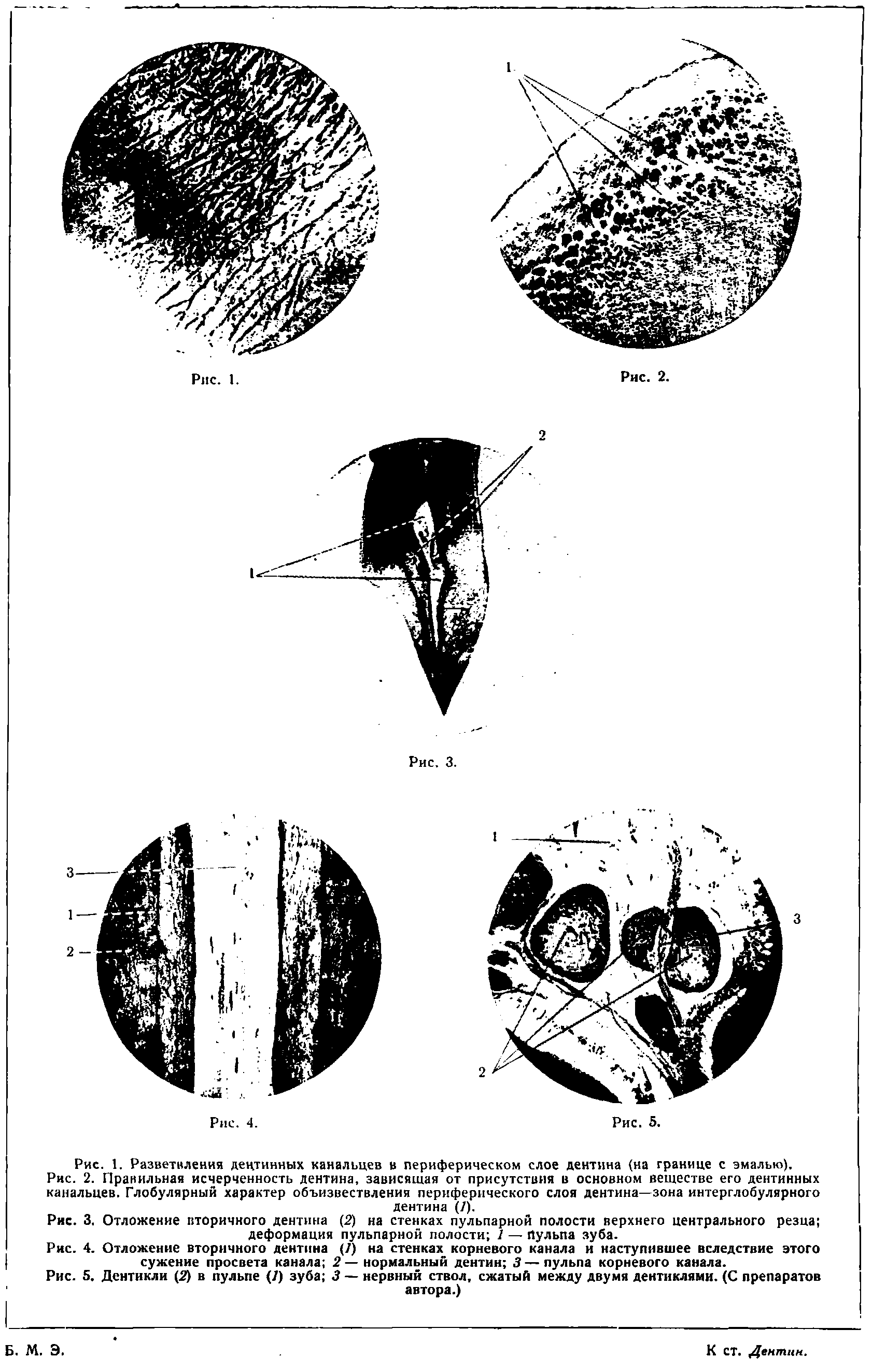 Рис. 4. Отложение вторичного дентина (7) на стенках корневого канала и наступившее вследствие этого сужение просвета канала 2— нормальный дентин 3—пульпа корневого канала.