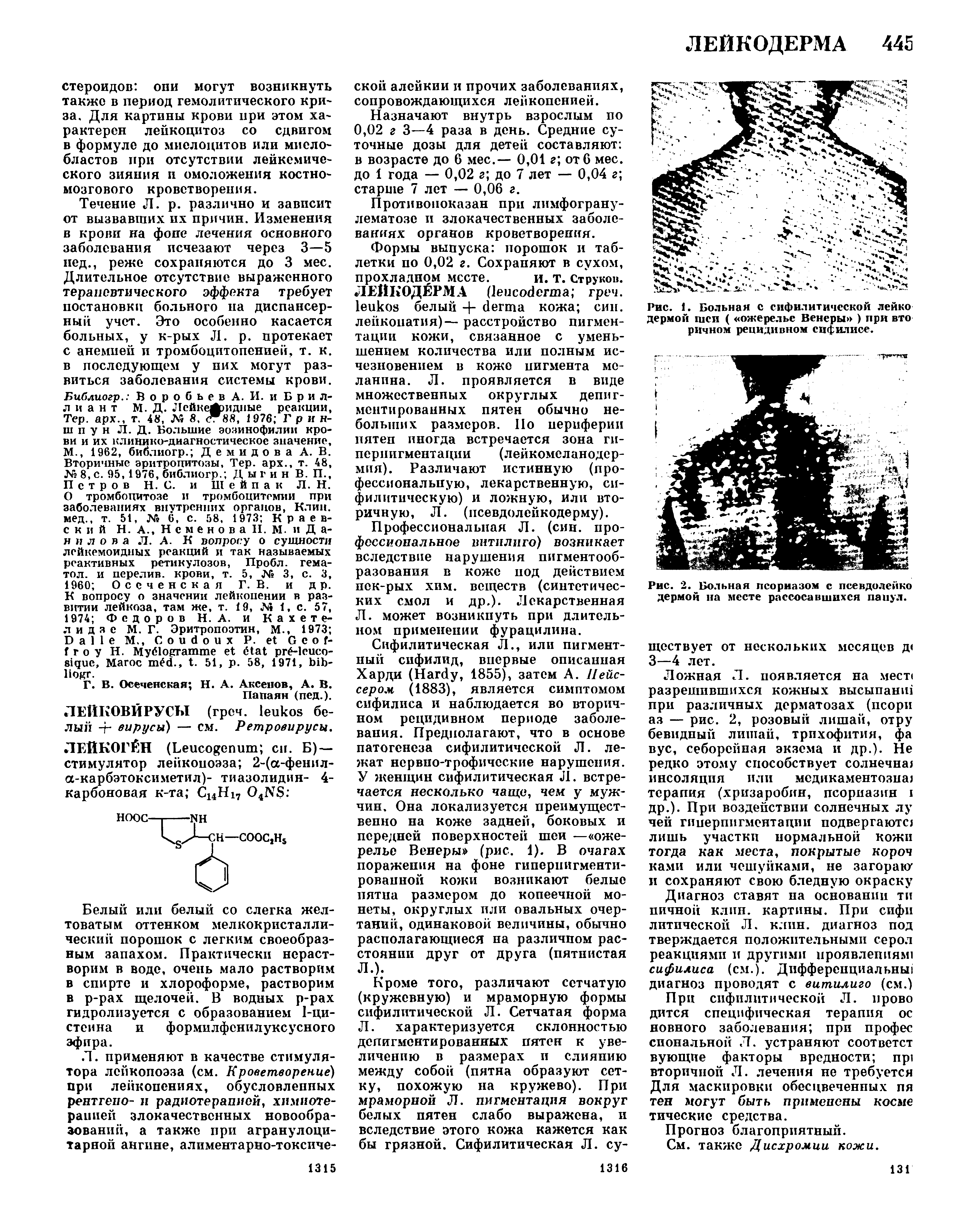 Рис. 1. Больная с сифилитической лейко дермой шеи ( ожерелье Венеры ) при вто ричном рецидивном сифилисе.