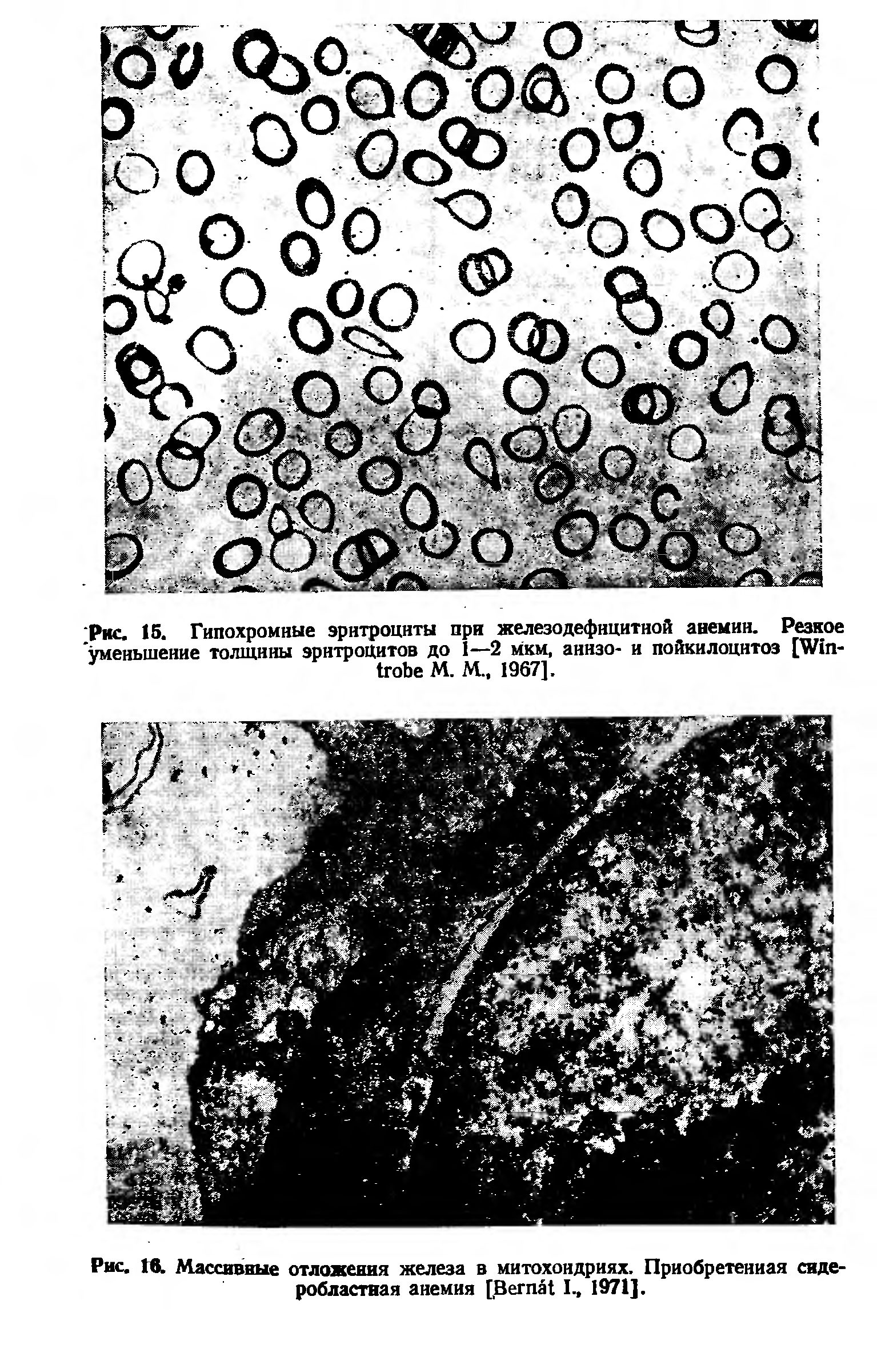 Рис. 16. Массивные отложения железа в митохондриях. Приобретенная сидеробластная анемия [B I., 1971].