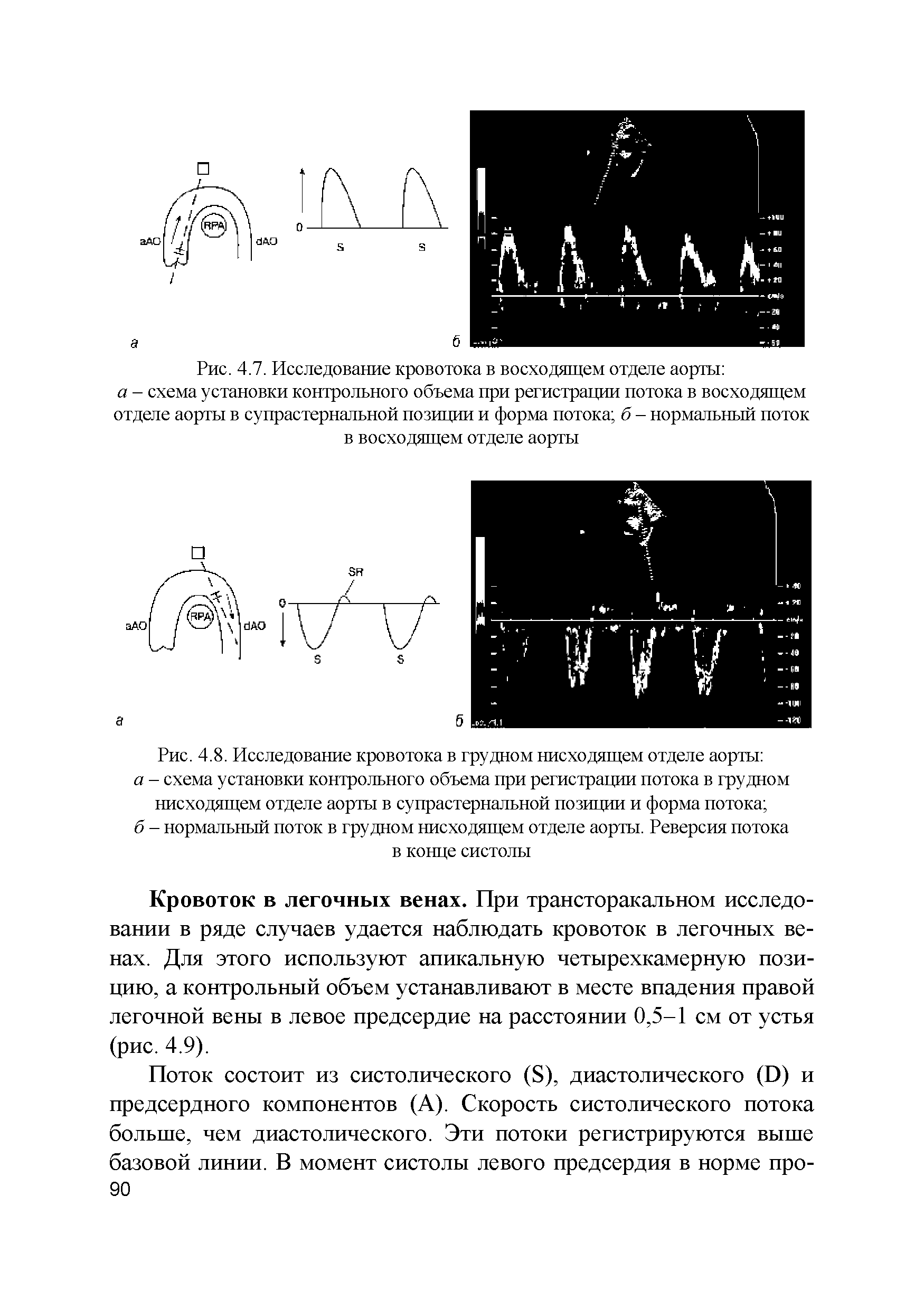 Рис. 4.8. Исследование кровотока в грудном нисходящем отделе аорты а - схема установки контрольного объема при регистрации потока в грудном нисходящем отделе аорты в супрастернальной позиции и форма потока ...