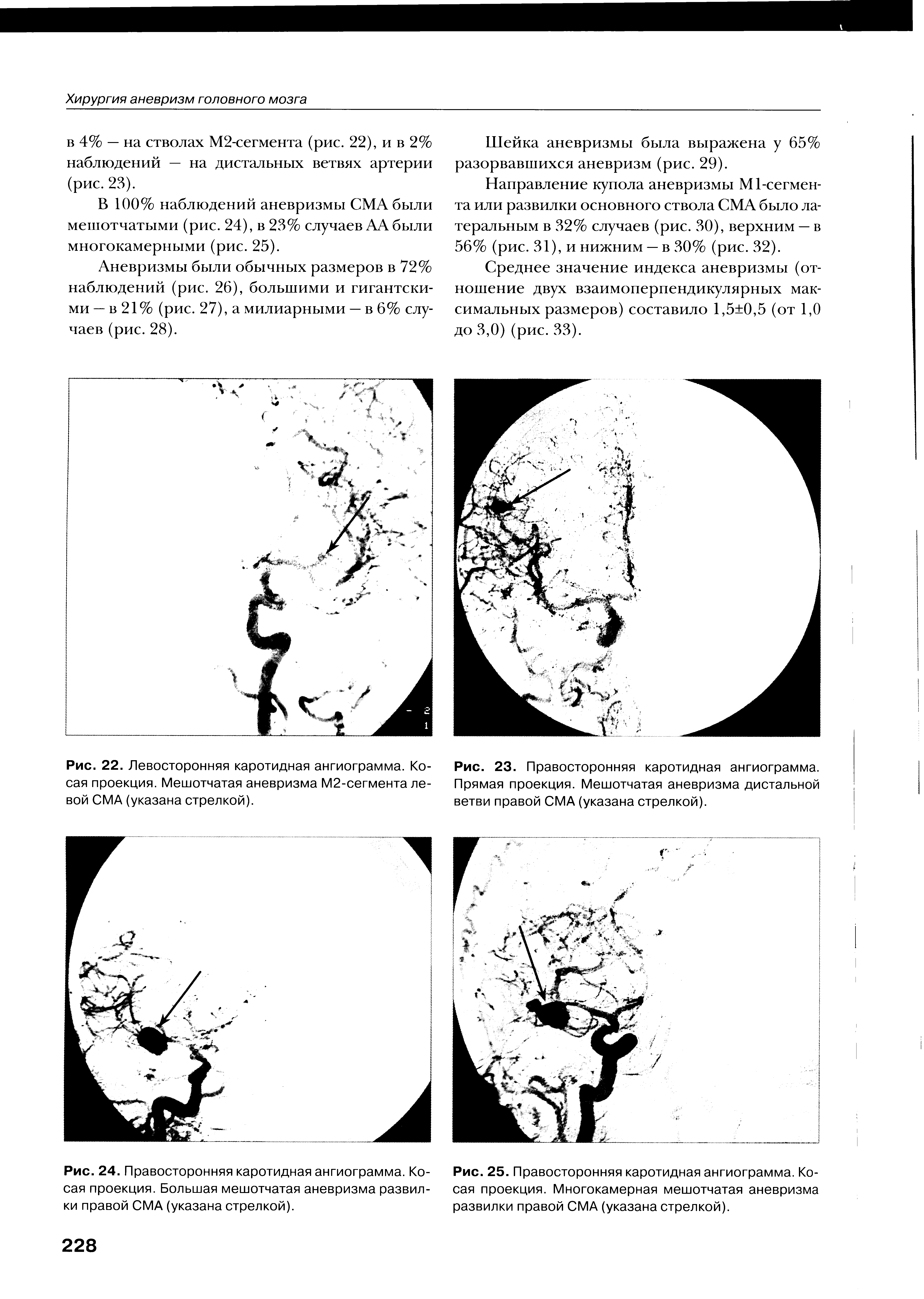 Рис. 24. Правосторонняя каротидная ангиограмма. Косая проекция. Большая мешотчатая аневризма развилки правой СМА (указана стрелкой).