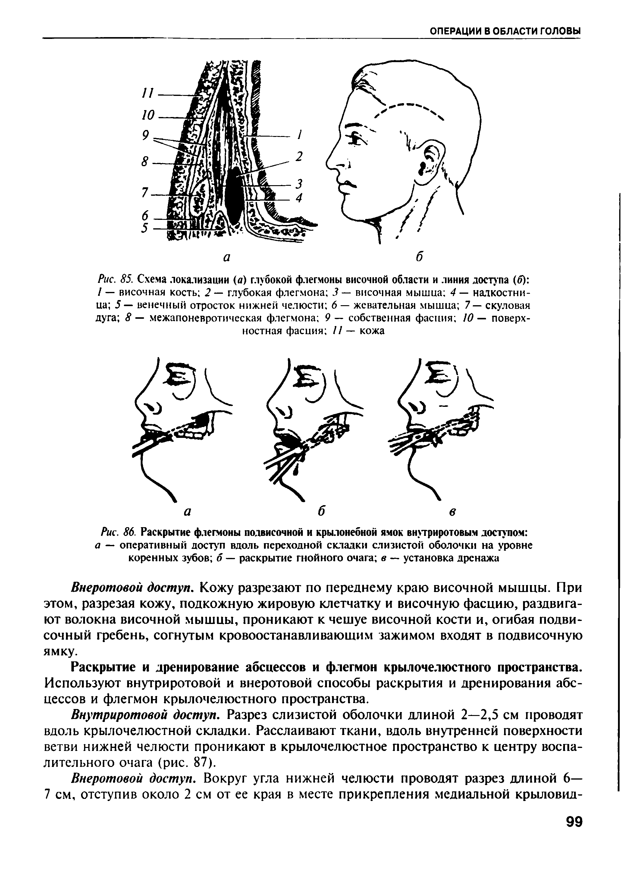 Рис. 86. Раскрытие флегмоны подвисочной и крылонебной ямок внутриротовым доступом а — оперативный доступ вдоль переходной складки слизистой оболочки на уровне коренных зубов б — раскрытие гнойного очага в — установка дренажа...