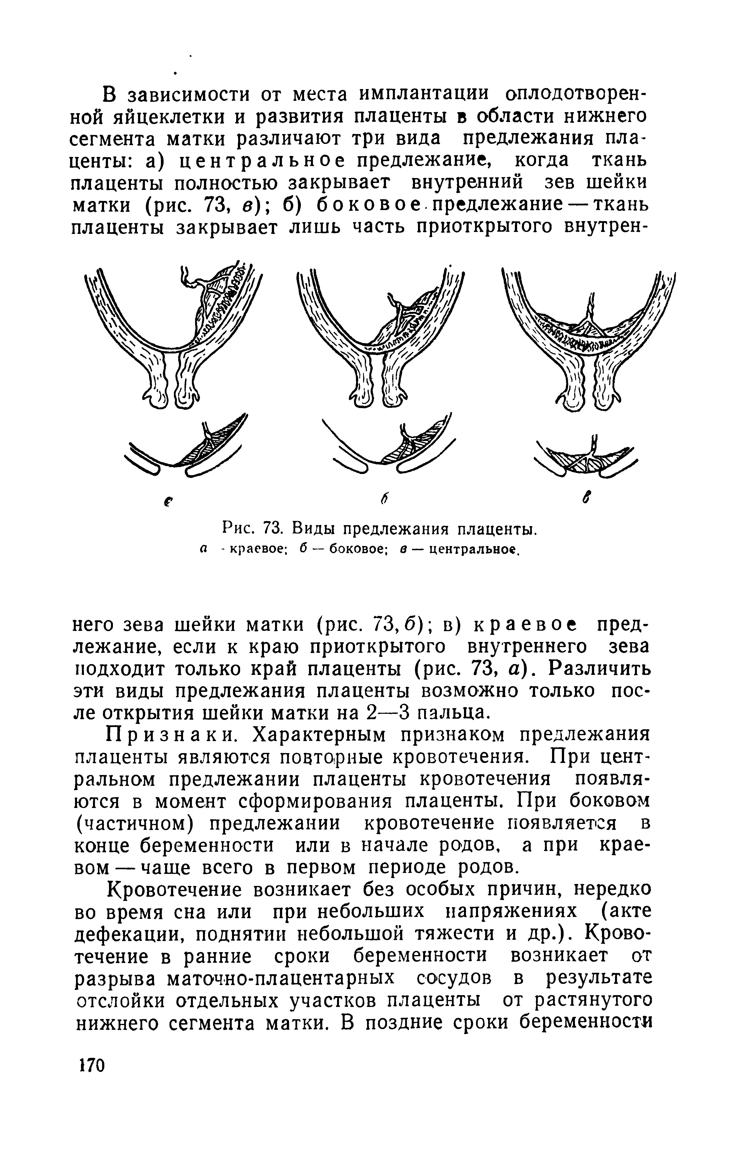 Рис. 73. Виды предлежания плаценты. а - краевое б — боковое в — центральное.