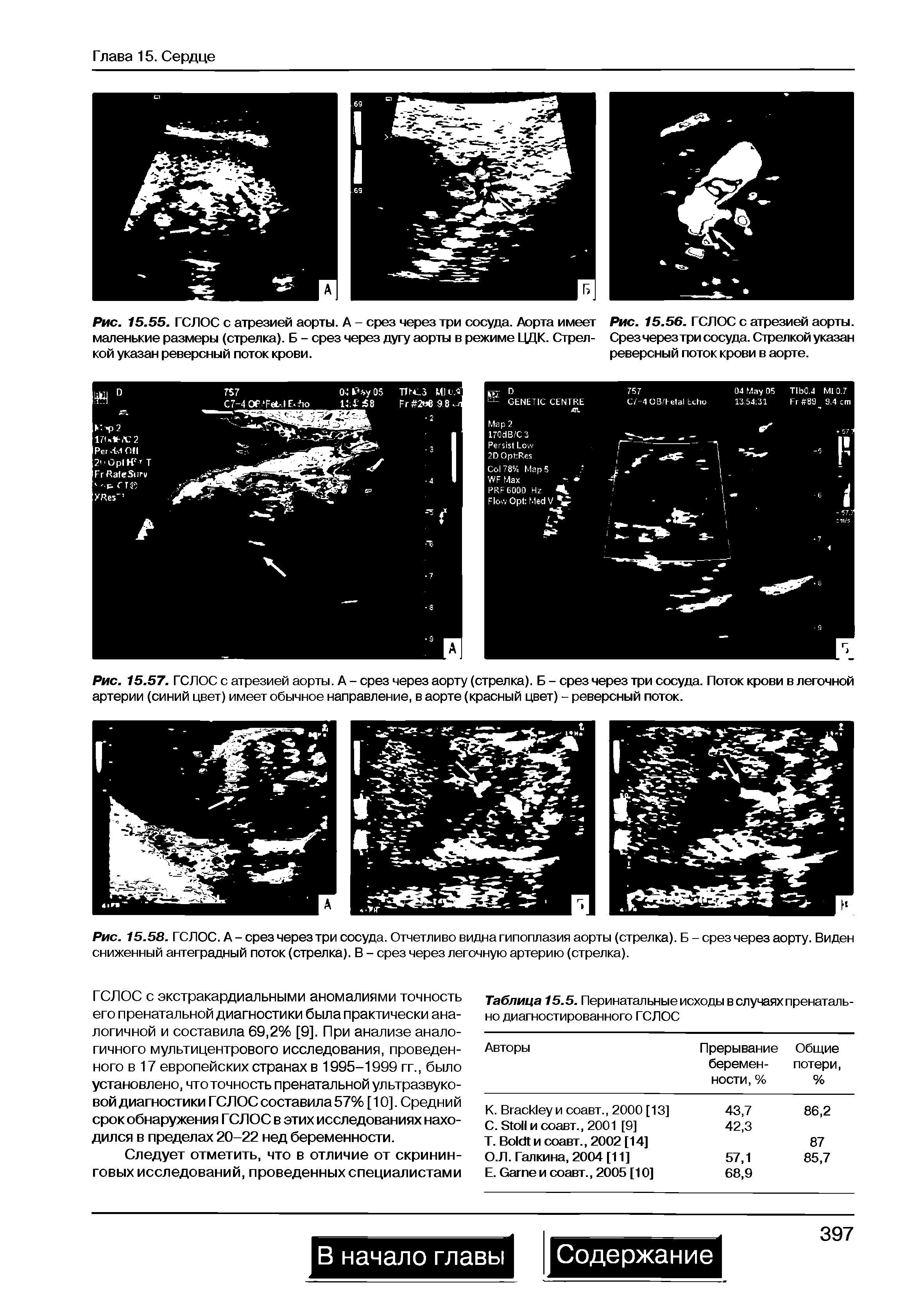 Рис. 15.55. ГСЛОС с атрезией аорты. А - срез через три сосуда. Аорта имеет маленькие размеры (стрелка). Б - срез через дугу аорты в режиме ЦДК. Стрелкой указан реверсный поток крови.