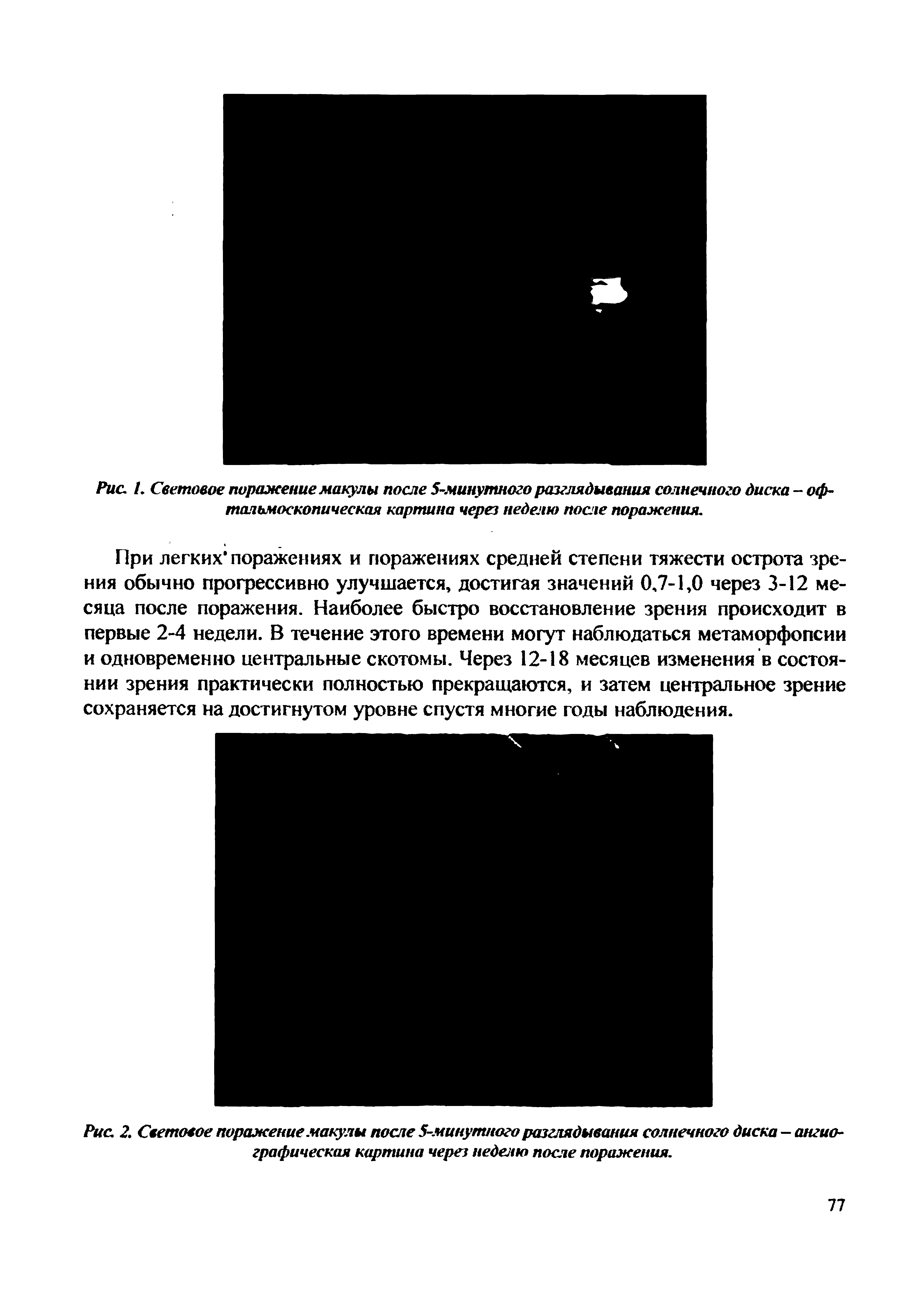 Рис. I. Световое поражение макулы после 5-минутного разглядывания солнечного диска - офтальмоскопическая картина через неделю после поражения.