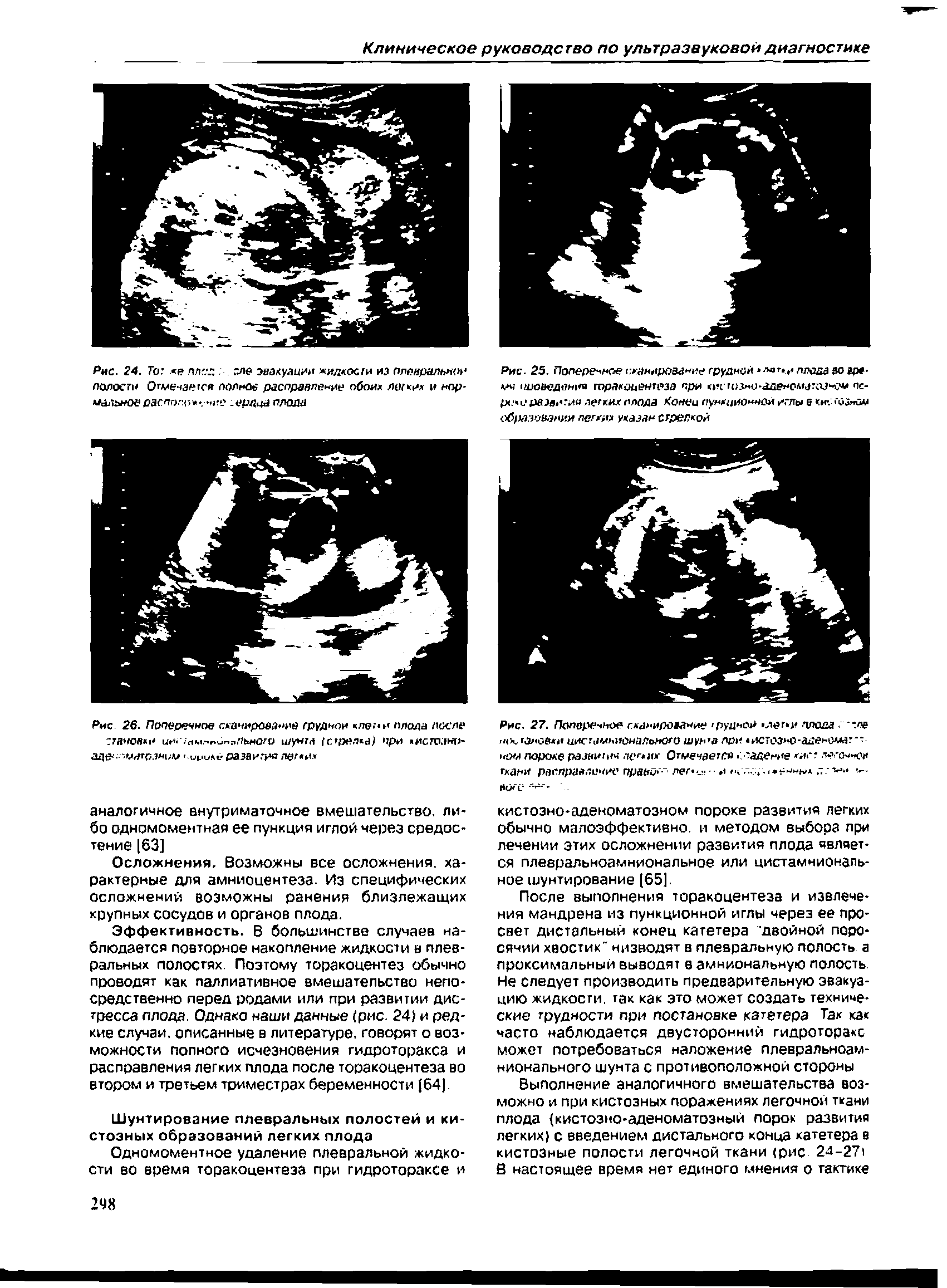 Рис. 25. Поперечное сканирование грудной лаъ.и плода во ре-мн чиоведон гораходвигрэл при < пгшми-аденолмки%ч пс-рс и развития легких плода Копей пункционной иглы в ки .ч Одом образования легких указан с грелкой...