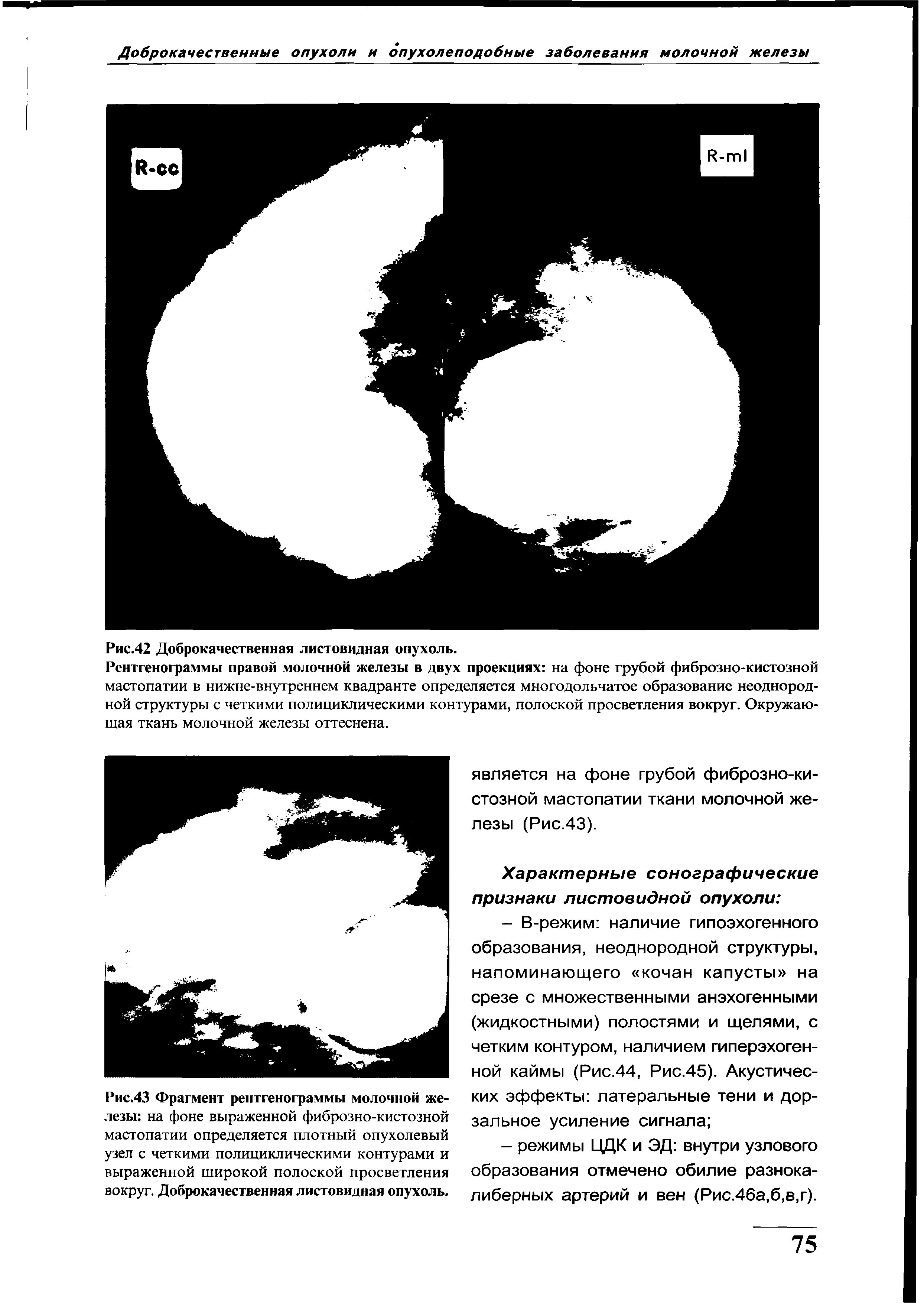 Рис.43 Фрагмент рентгенограммы молочной железы на фоне выраженной фиброзно-кистозной мастопатии определяется плотный опухолевый узел с четкими полициклическими контурами и выраженной широкой полоской просветления вокруг. Доброкачественная листовидная опухоль.