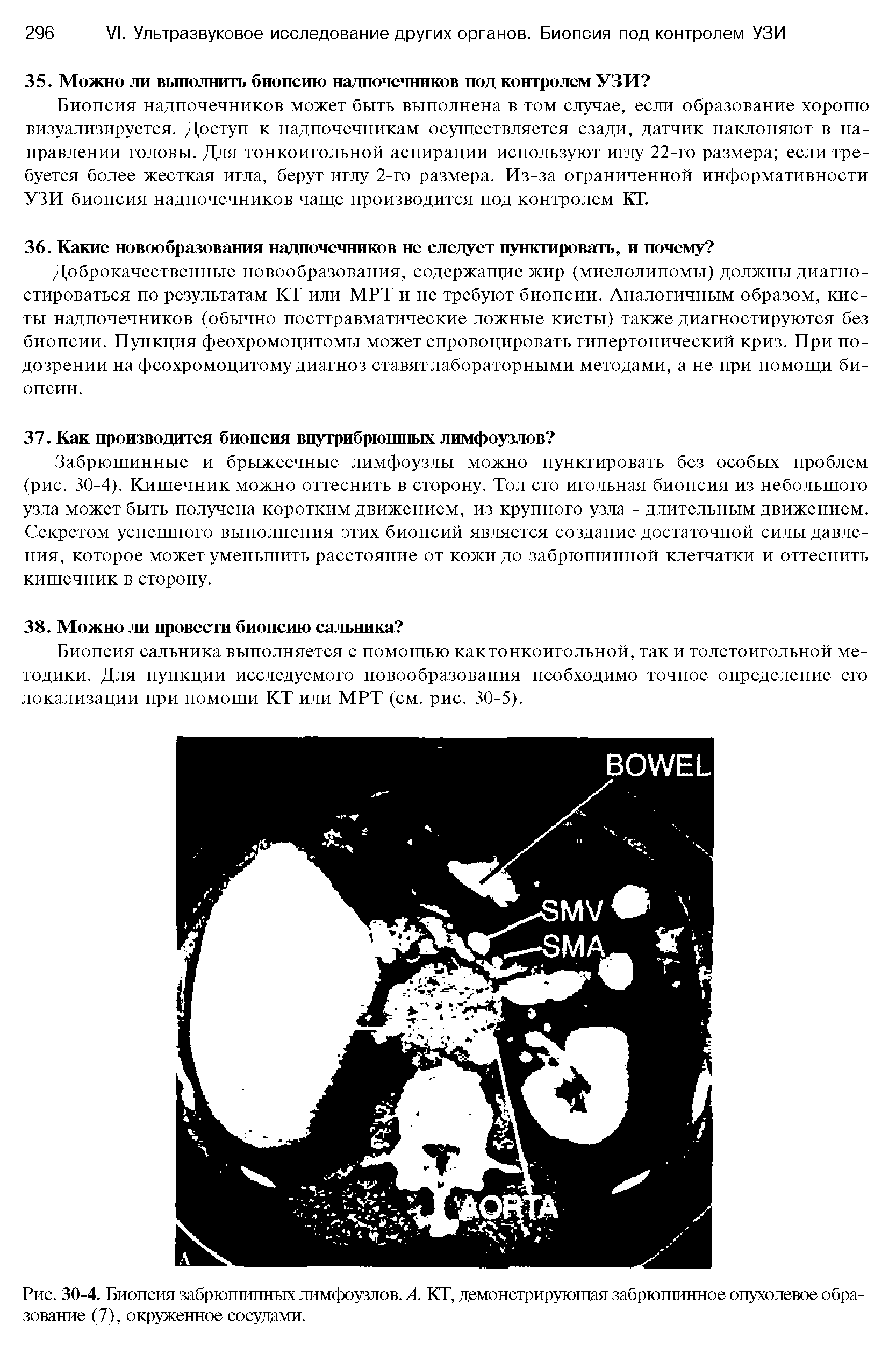 Рис. 30-4. Биопсия забрюшипных лимфоузлов. А. КТ, демонстрирующая забрюшинное опухолевое образование (7), окруженное сосудами.