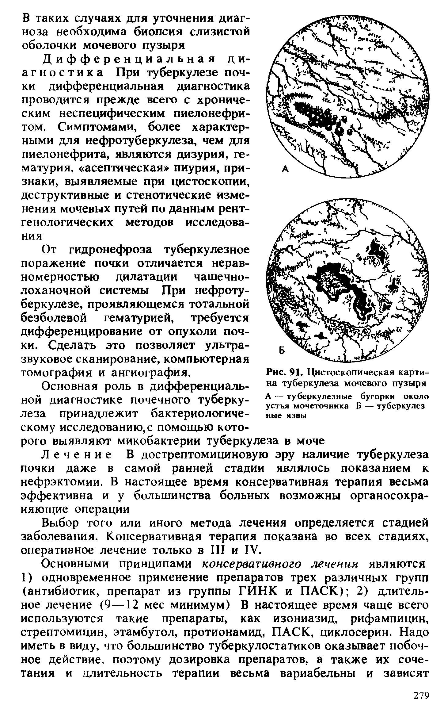 Рис. 91. Цистоскопическая картина туберкулеза мочевого пузыря А — туберкулезные бугорки около устья мочеточника Б — туберкулез ные язвы...