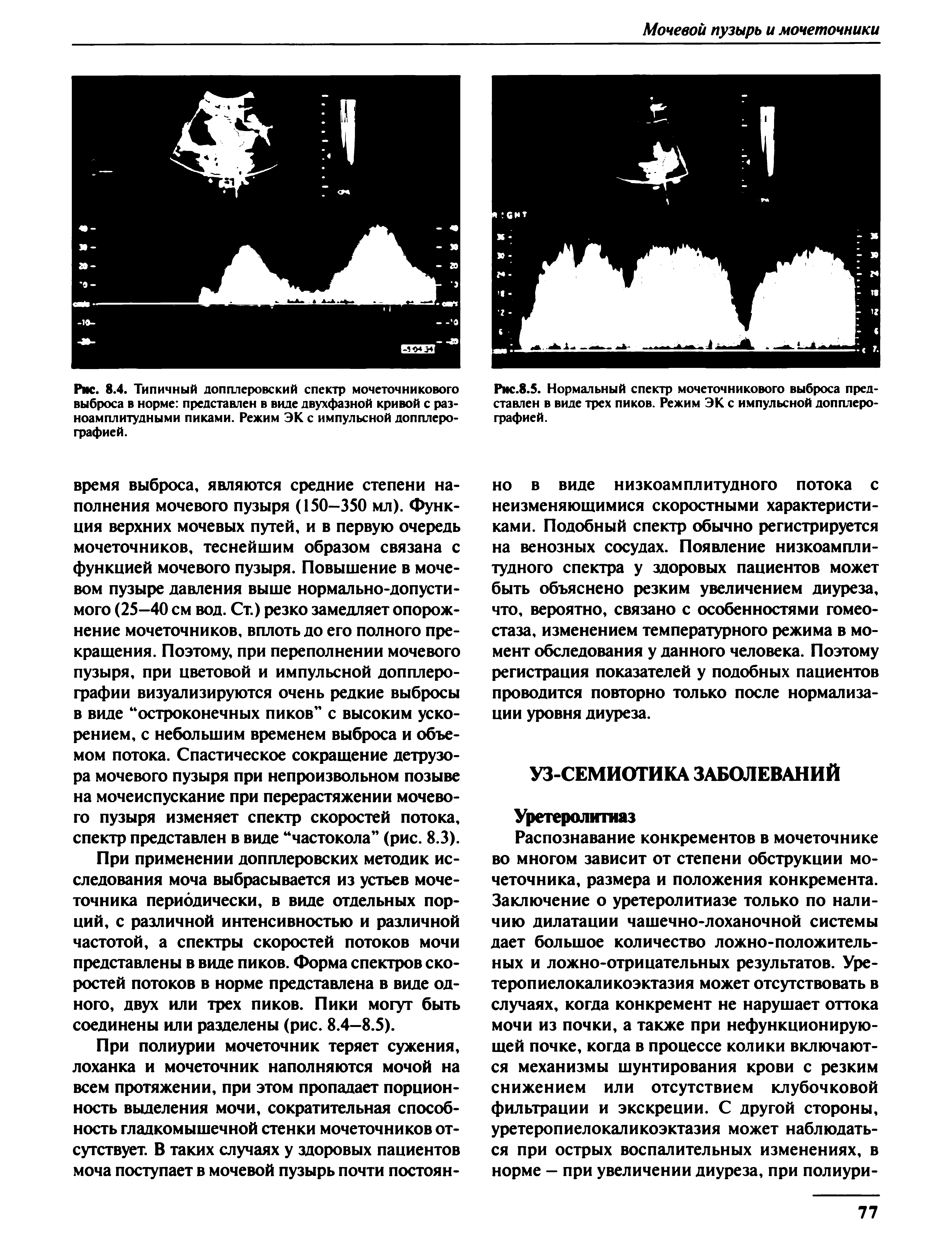 Рис. 8.4. Типичный допплеровский спектр мочеточникового выброса в норме представлен в виде двухфазной кривой с разноамплитудными пиками. Режим ЭК с импульсной допплерографией.