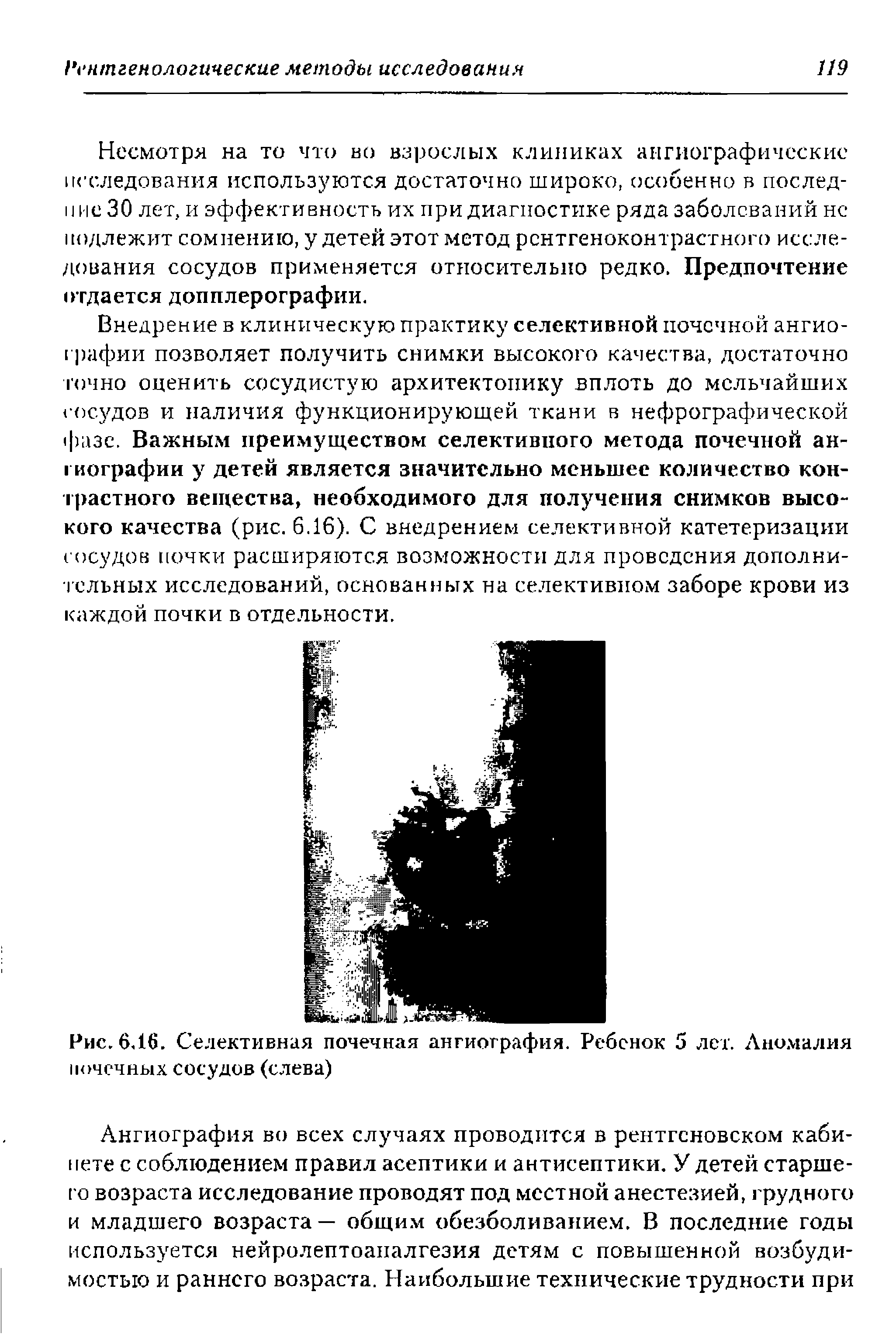 Рис. 6,16. Селективная почечная ангиография. Ребенок 5 лет. Аномалия почечных сосудов (слева)...