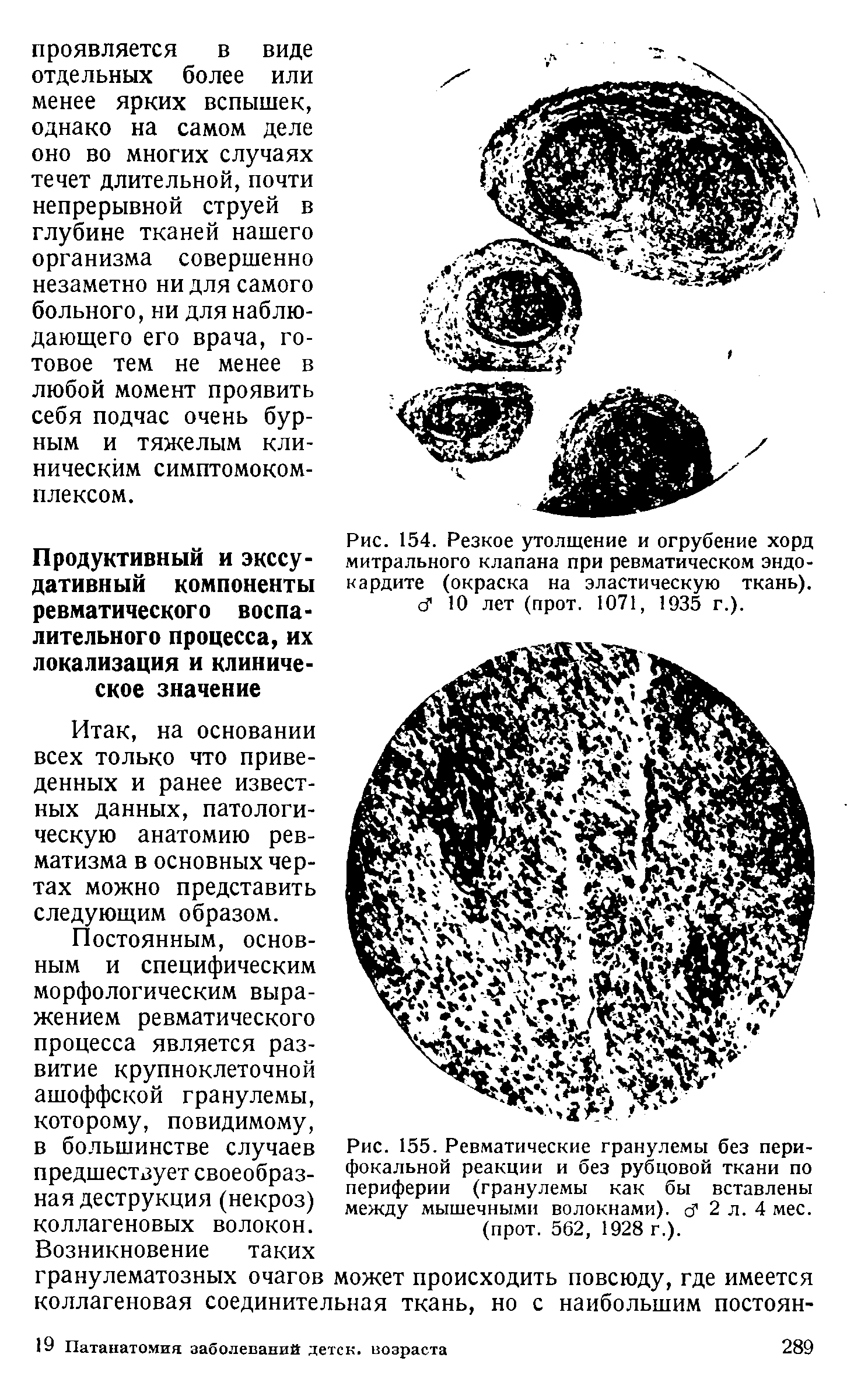 Рис. 154. Резкое утолщение и огрубение хорд митрального клапана при ревматическом эндокардите (окраска на эластическую ткань). сГ 10 лет (прот. 1071, 1935 г.).