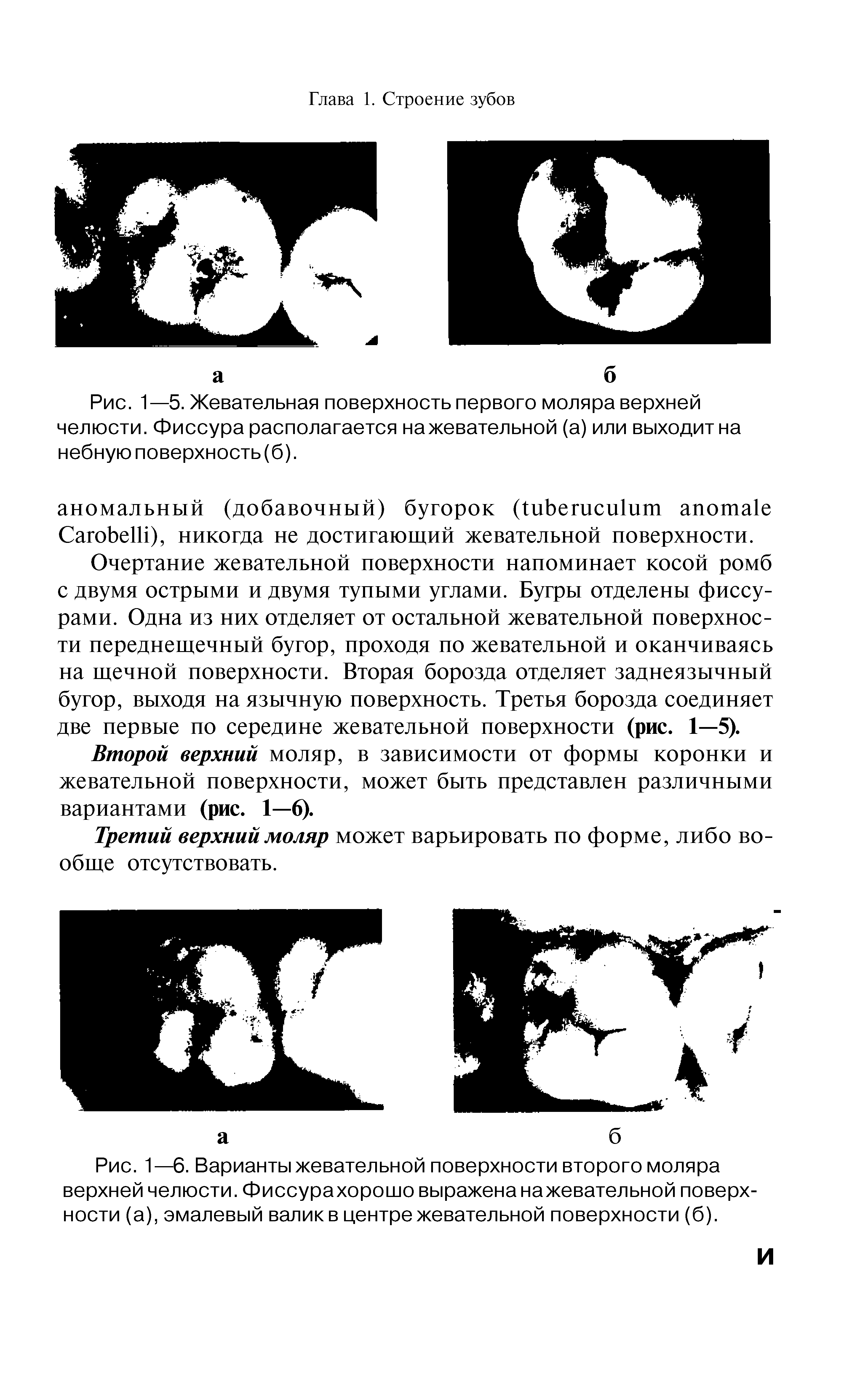 Рис. 1—6. Варианты жевательной поверхности второго моляра верхней челюсти. Фиссурахорошо выражена нажевательной поверхности (а), эмалевый валик в центре жевательной поверхности (б).