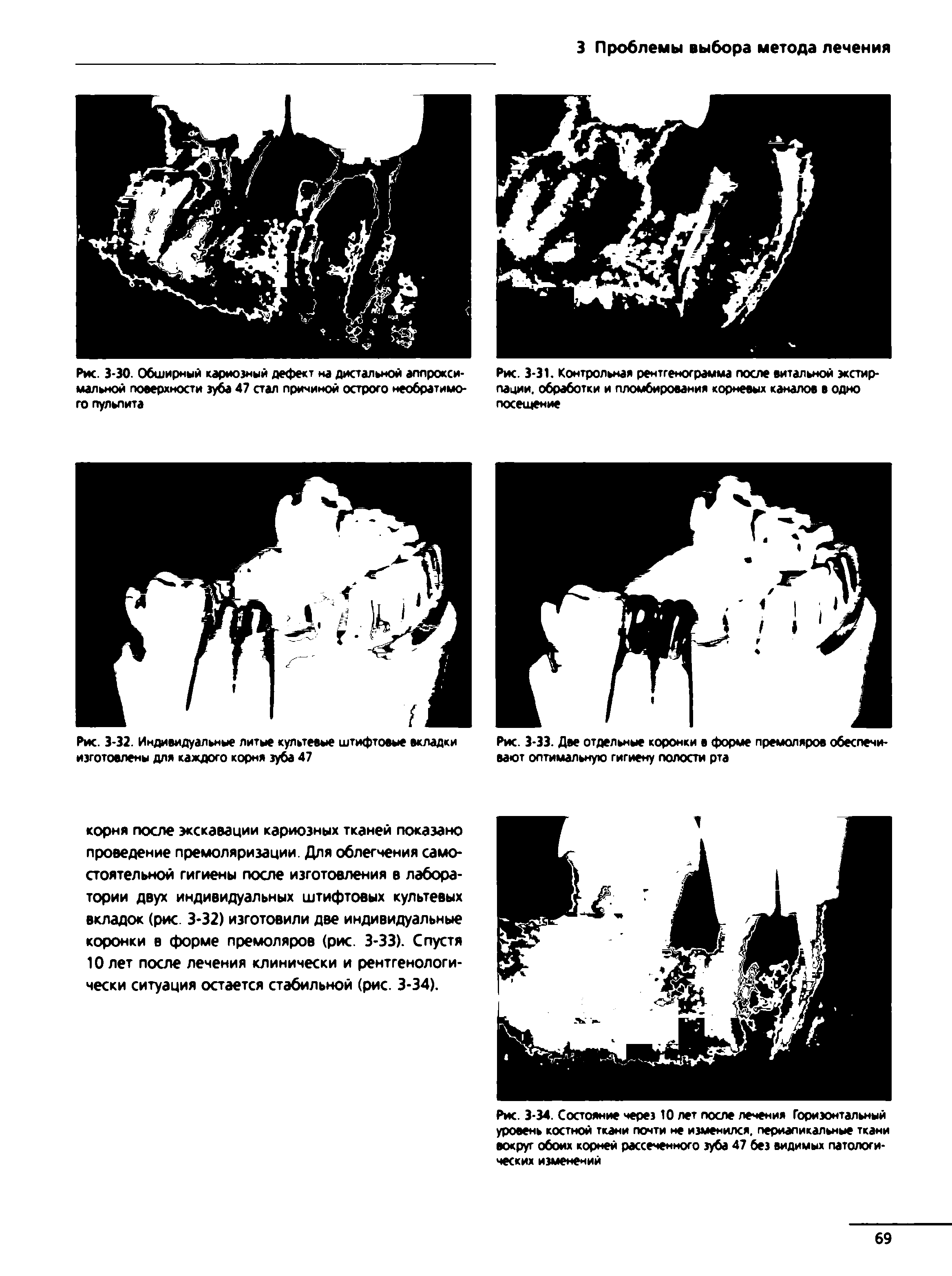 Рис. 3-34. Состояние через 10 лет после лечения Горизонтальный уровень костной ткани почти не изменился, периапикальные ткани вокруг обоих корней рассеченного зуба 47 без видимых патологических изменений...
