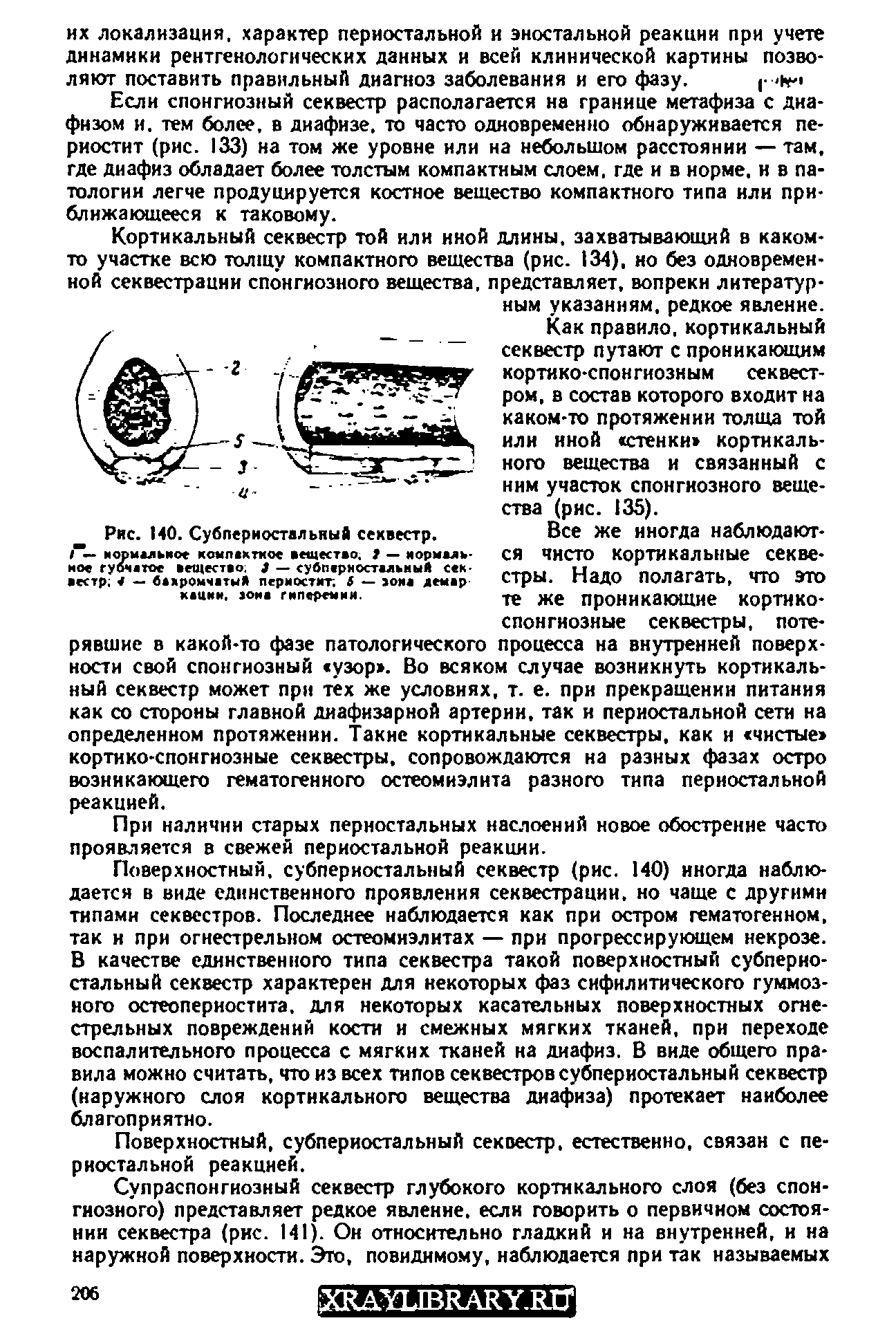 Рис. 140. Субпериостальный секвестр. / — нормальное компахтиое вещество. 1 — нормальное губчатое вещество. 3 — субпериостальный секвестр 4 — бахромчатый периостит. 6 — эоиа денар-каики, зона гиперемии.