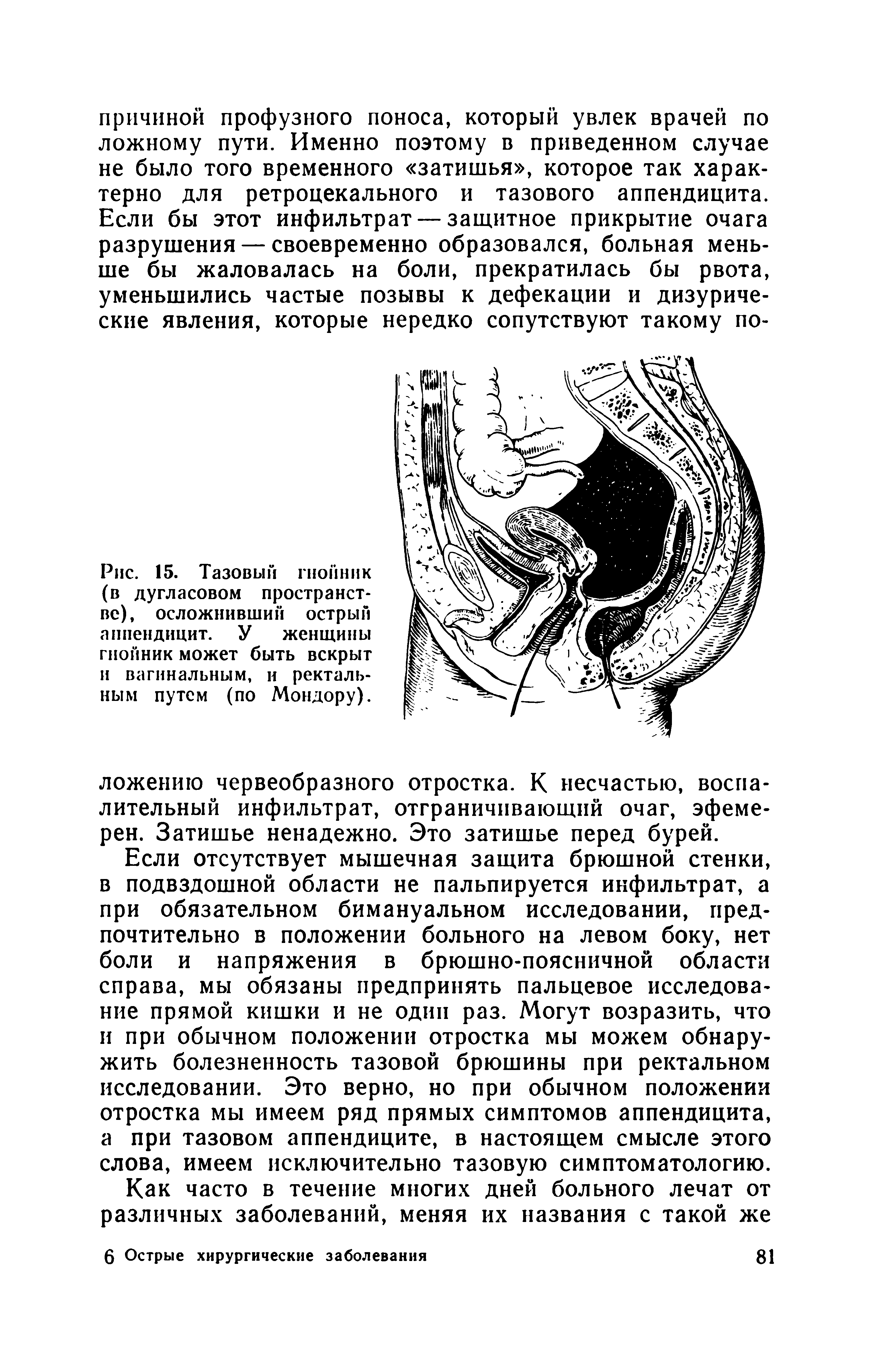 Рис. 15. Тазовый гнойник (в дугласовом пространстве), осложнивший острый аппендицит. У женщины гнойник может быть вскрыт и вагинальным, и ректальным путем (по Мондору).