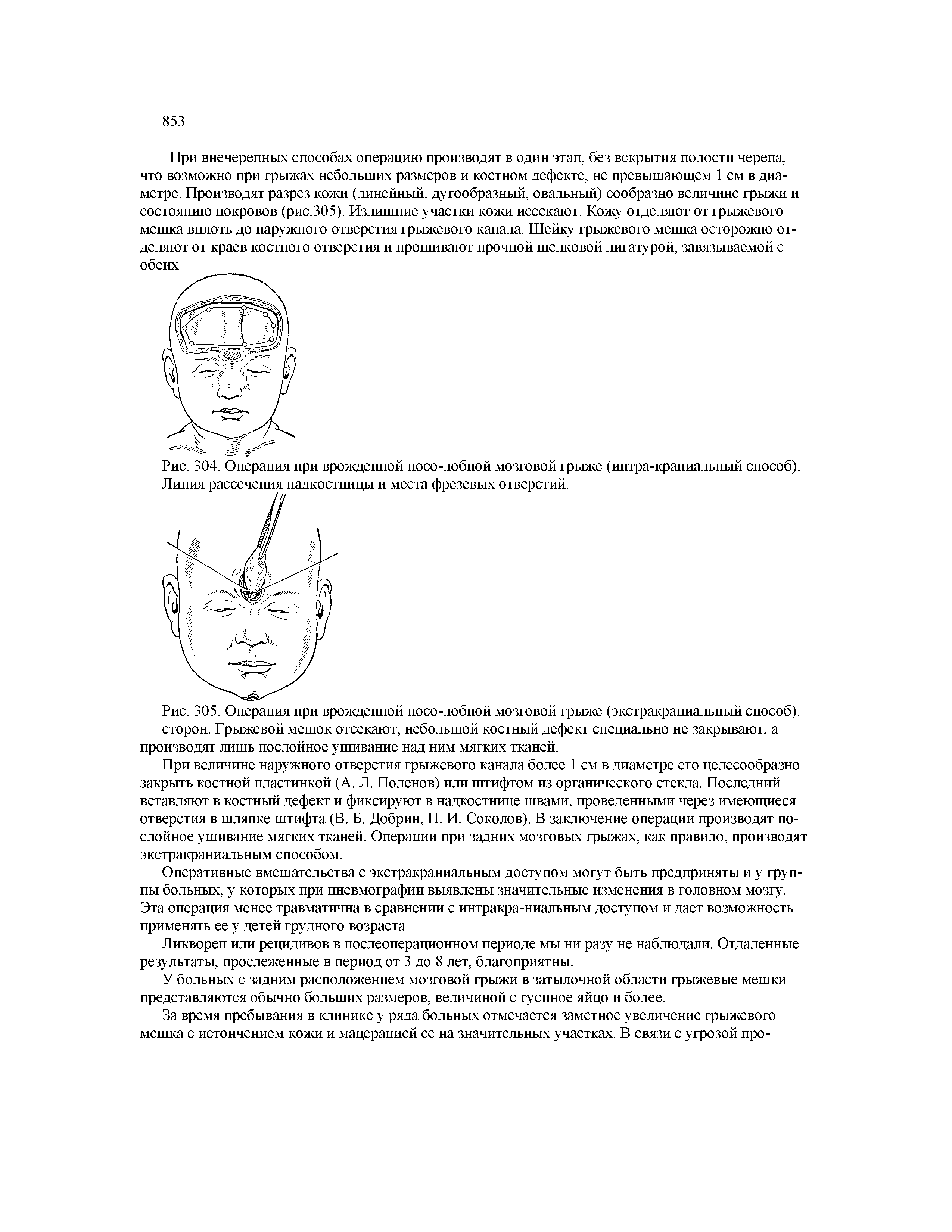 Рис. 305. Операция при врожденной носо-лобной мозговой грыже (экстракраниальный способ), сторон. Грыжевой мешок отсекают, небольшой костный дефект специально не закрывают, а производят лишь послойное ушивание над ним мягких тканей.