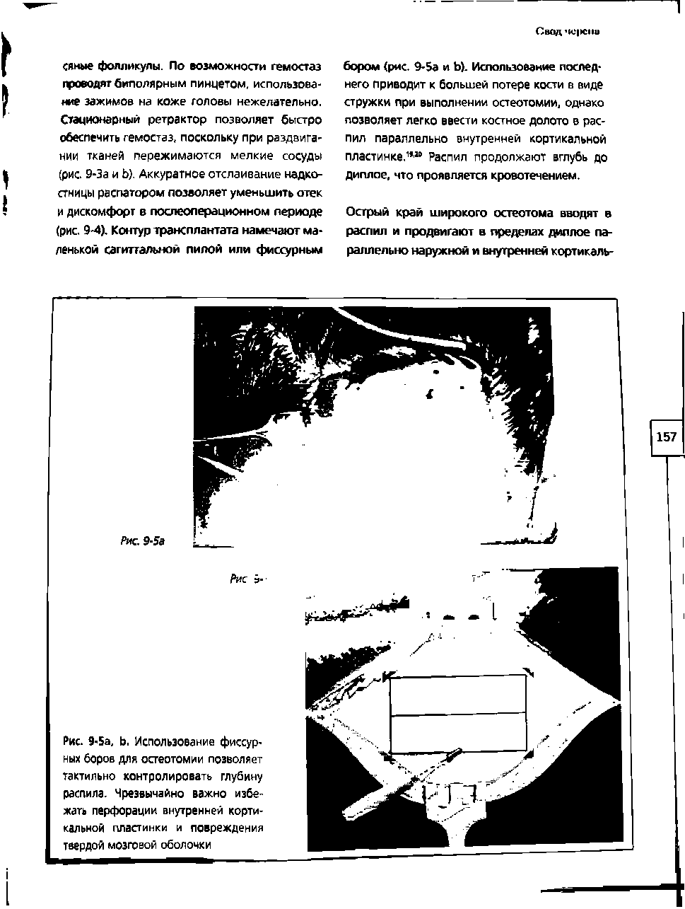 Рис. 9-5а, Ь, Использование фиссурных боров для остеотомии позволяет тактильно контролировать глубину распила. Чрезвычайно важно избежать перфорации внутренней кортикальной пластинки и повреждения твердой мозговой оболочки...