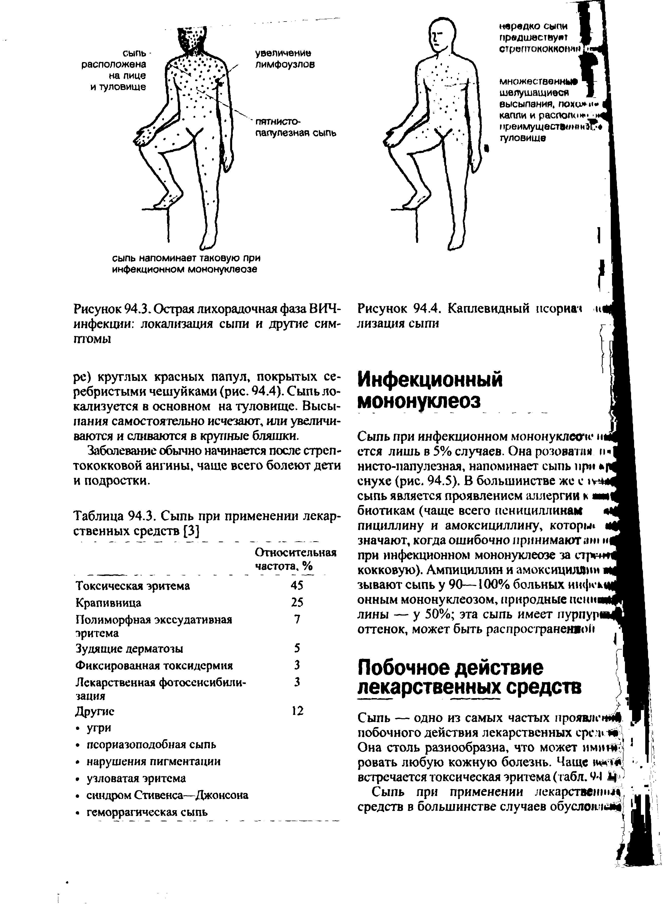 Рисунок 94.3. Острая лихорадочная фаза ВИЧ-инфекции локализация сыпи и другие симптомы...