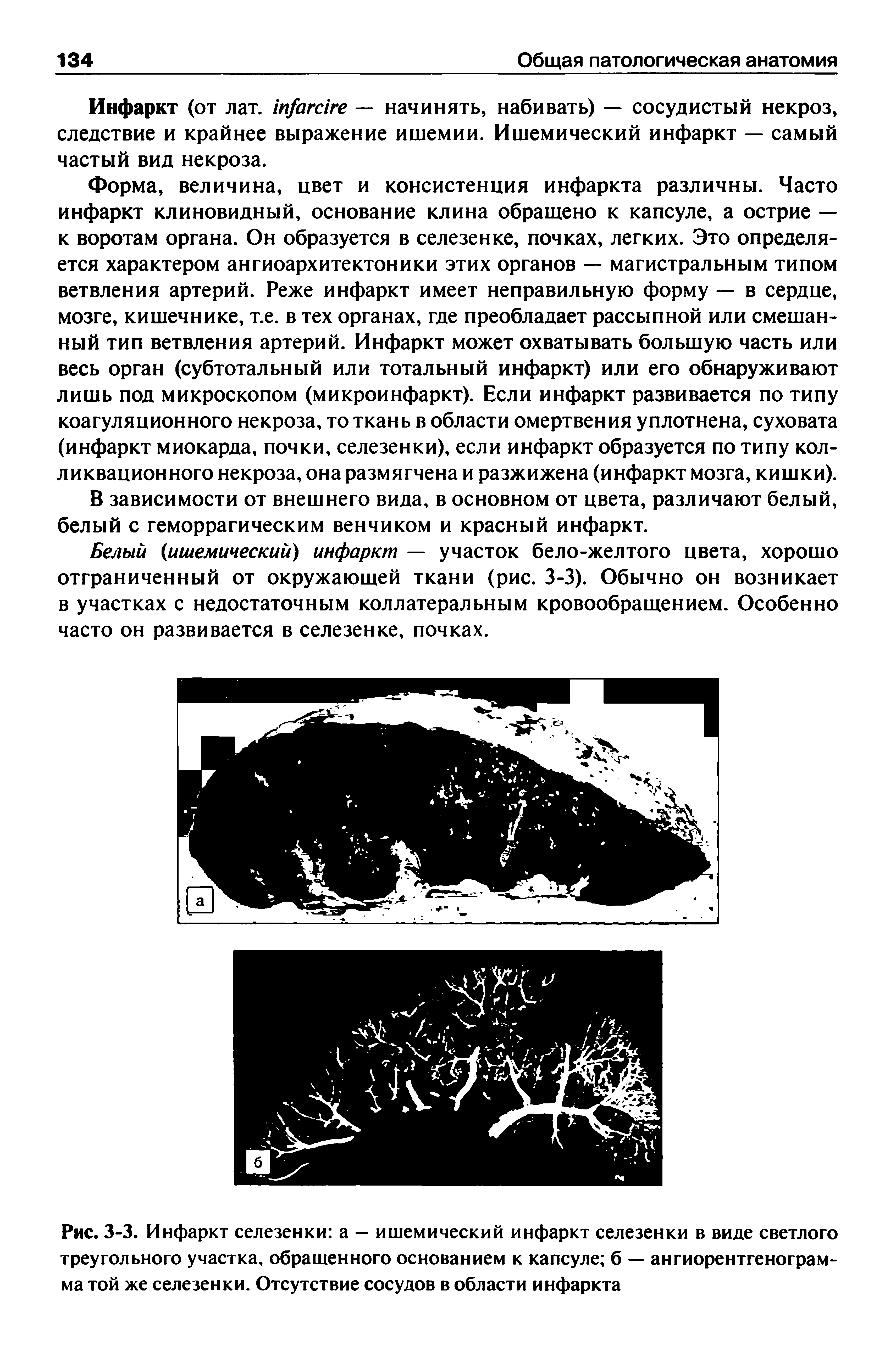 Рис. 3-3. Инфаркт селезенки а - ишемический инфаркт селезенки в виде светлого треугольного участка, обращенного основанием к капсуле б — ангиорентгенограмма той же селезенки. Отсутствие сосудов в области инфаркта...