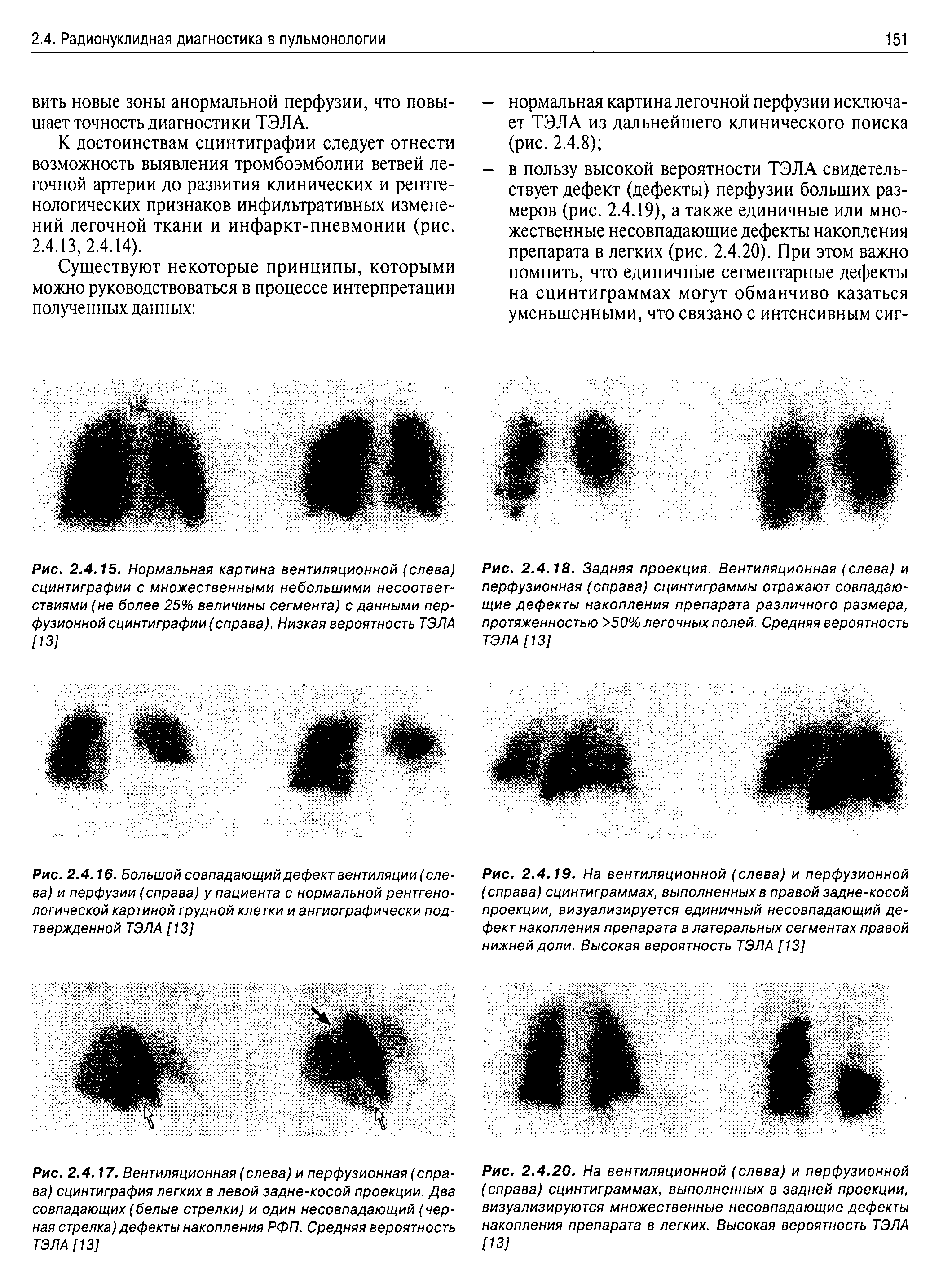 Рис. 2.4.19. На вентиляционной (слева) и перфузионной (справа) сцинтиграммах, выполненных в правой задне-косой проекции, визуализируется единичный несовпадающий дефект накопления препарата в латеральных сегментах правой нижней доли. Высокая вероятность ТЭЛА [ 13]...