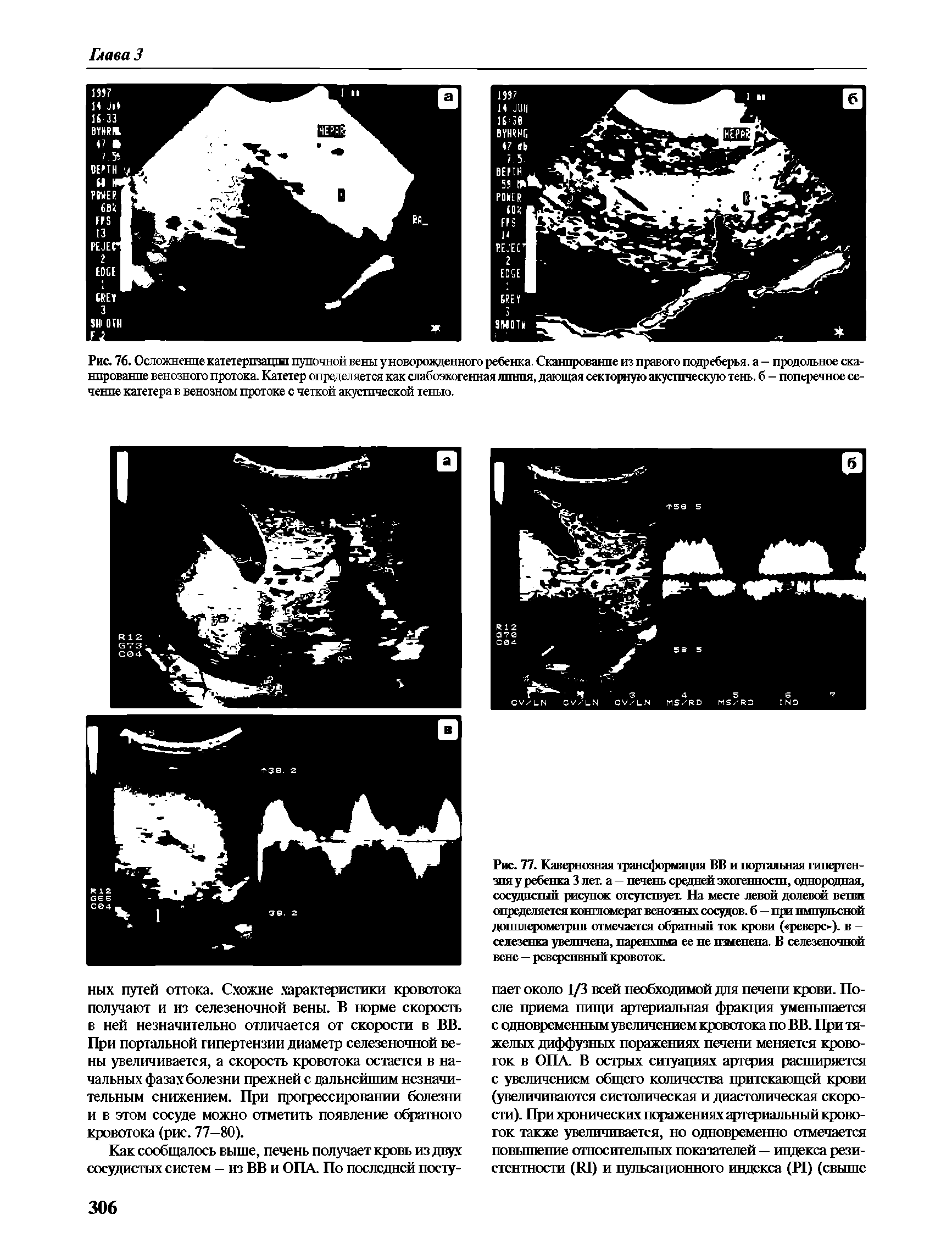 Рис. 77. Кавернозная трансформация ВВ и порталшая гипертензия у ребенка 3 лет. а — печень средней эхогенности, однородная, сосудистый рисунок отсутствует. На месте левой долевой ветви определяется конгломерат венозных сосудов, б — при импульсной допплерометрии отмечается обратный ток крови ( реверс ), в -селезенка увеличена, паренхима ее не изменена. В селезеночной вене — реверсивный кровоток.