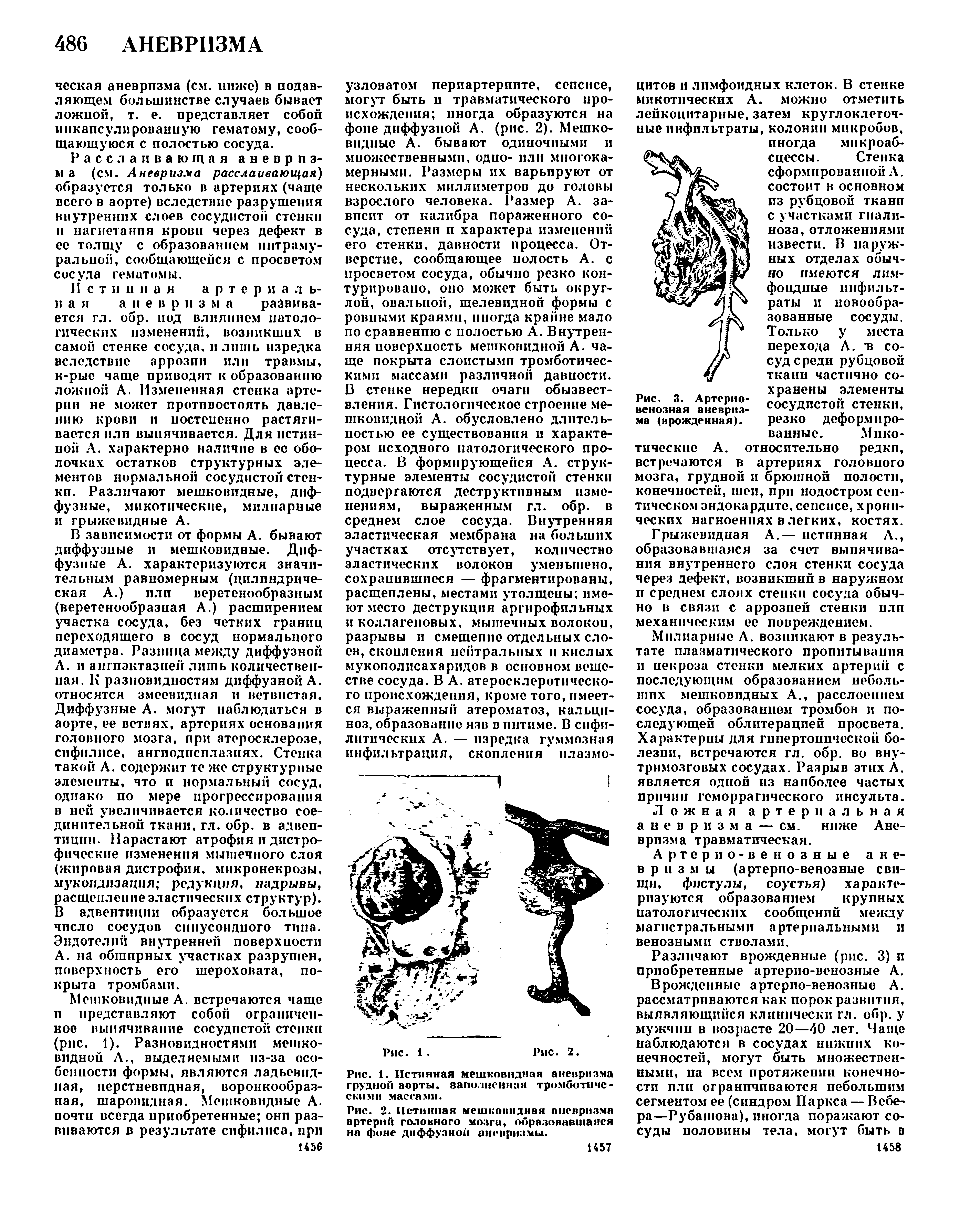 Рис. 2. Истинная мешковидная аневризма артерий головного мозги, образовавшаяся на фоне диффузной аневризмы.