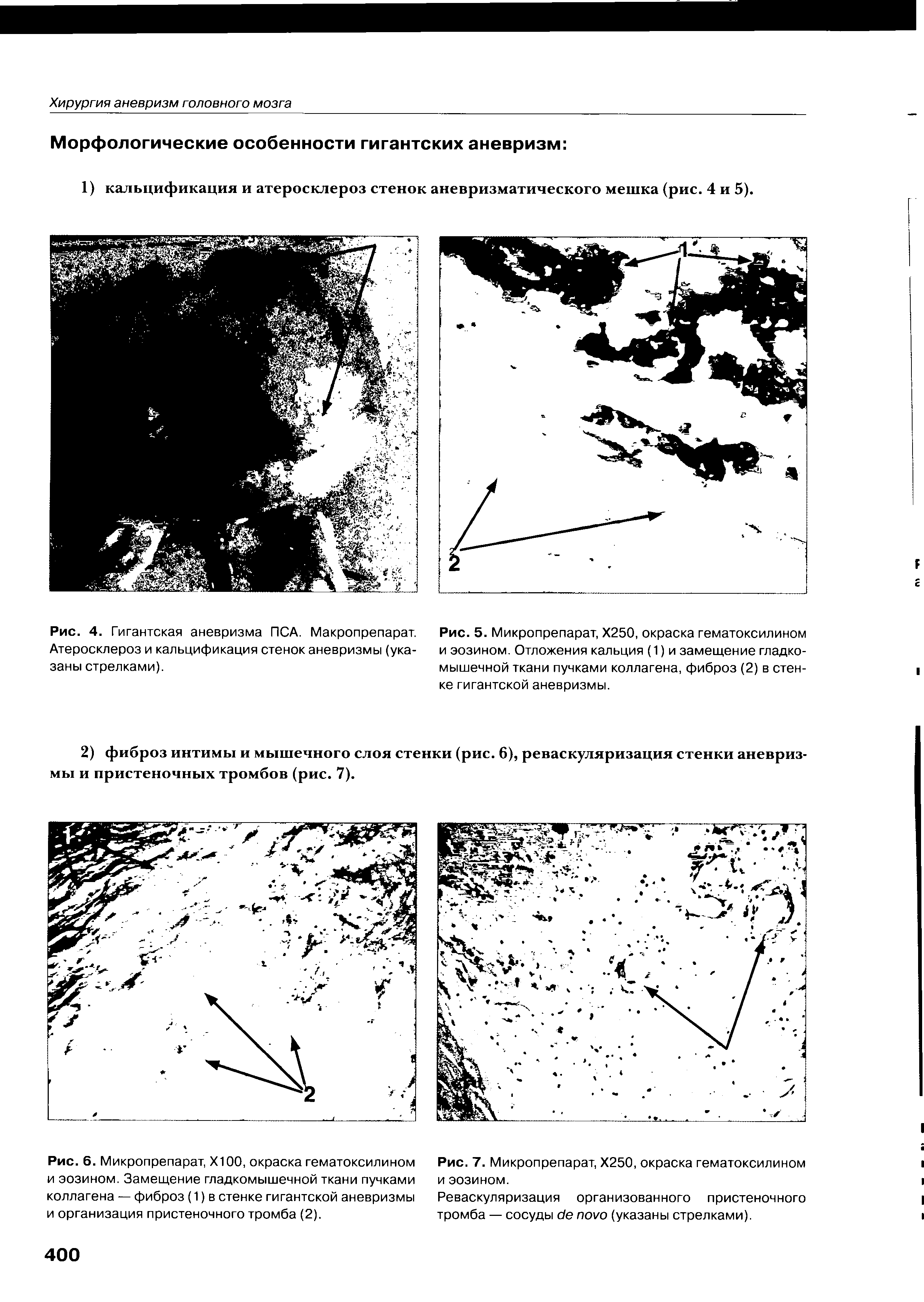 Рис. 4. Гигантская аневризма ПСА. Макропрепарат. Атеросклероз и кальцификация стенок аневризмы (указаны стрелками).