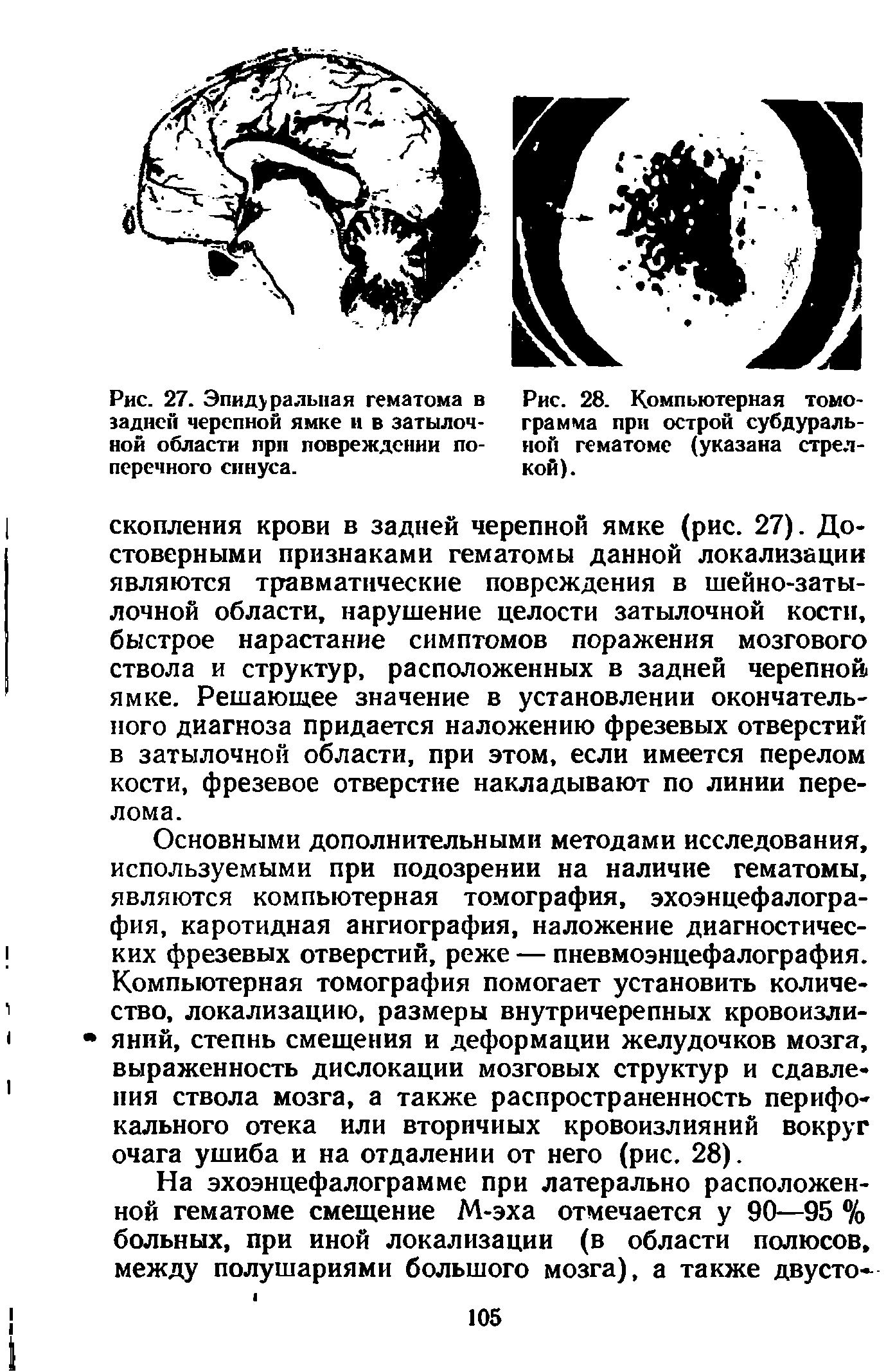 Рис. 28. Компьютерная томограмма при острой субдуральной гематоме (указана стрелкой).