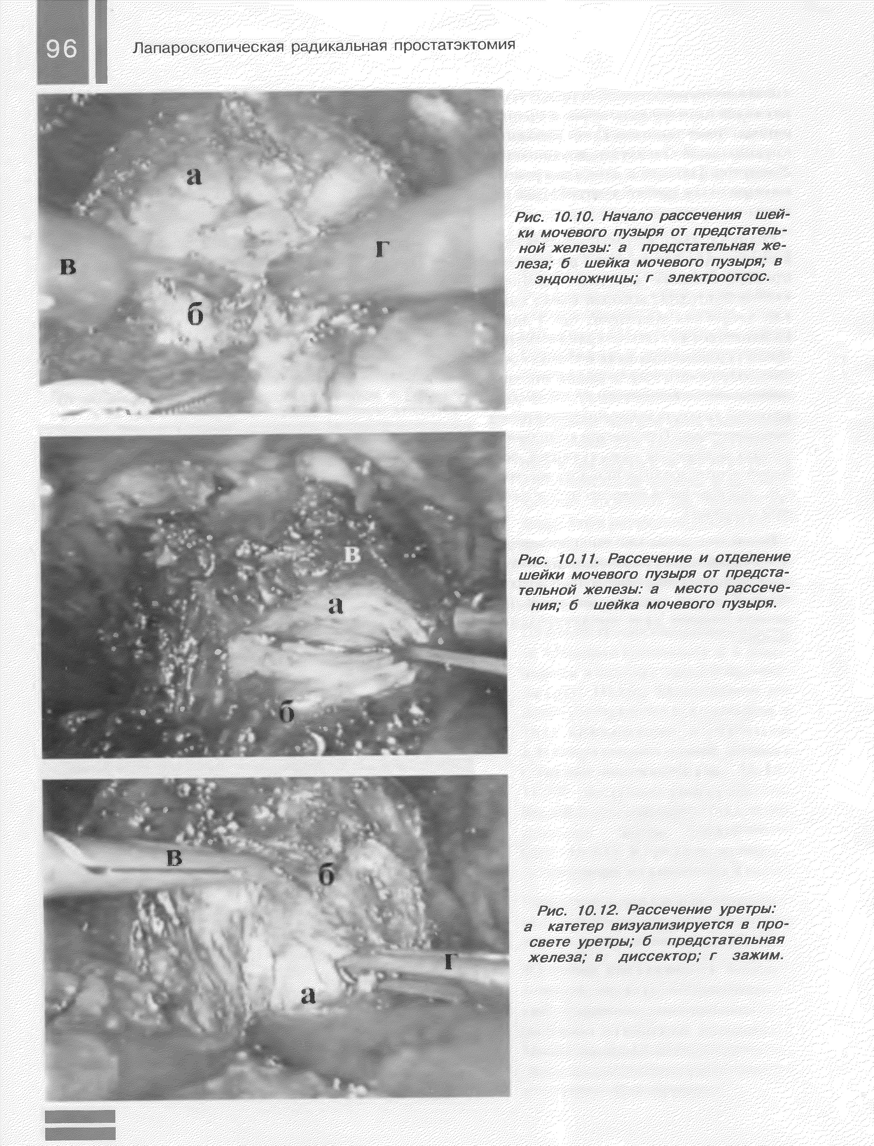Рис. 10.11. Рассечение и отделение шейки мочевого пузыря от предстательной железы а место рассечения б шейка мочевого пузыря.