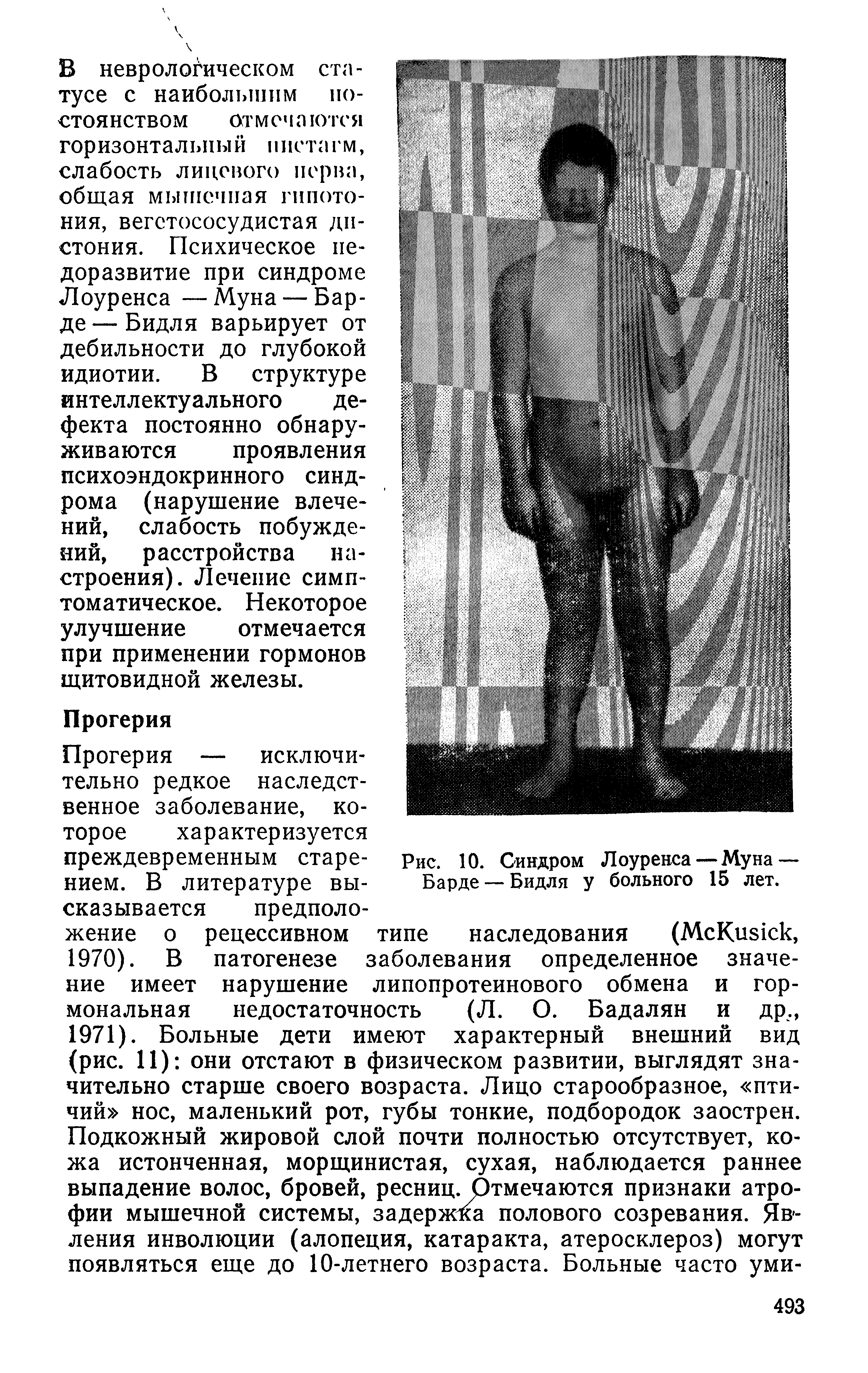 Рис. 10. Синдром Лоуренса —Муна — Барде —Бидля у больного 15 лет.