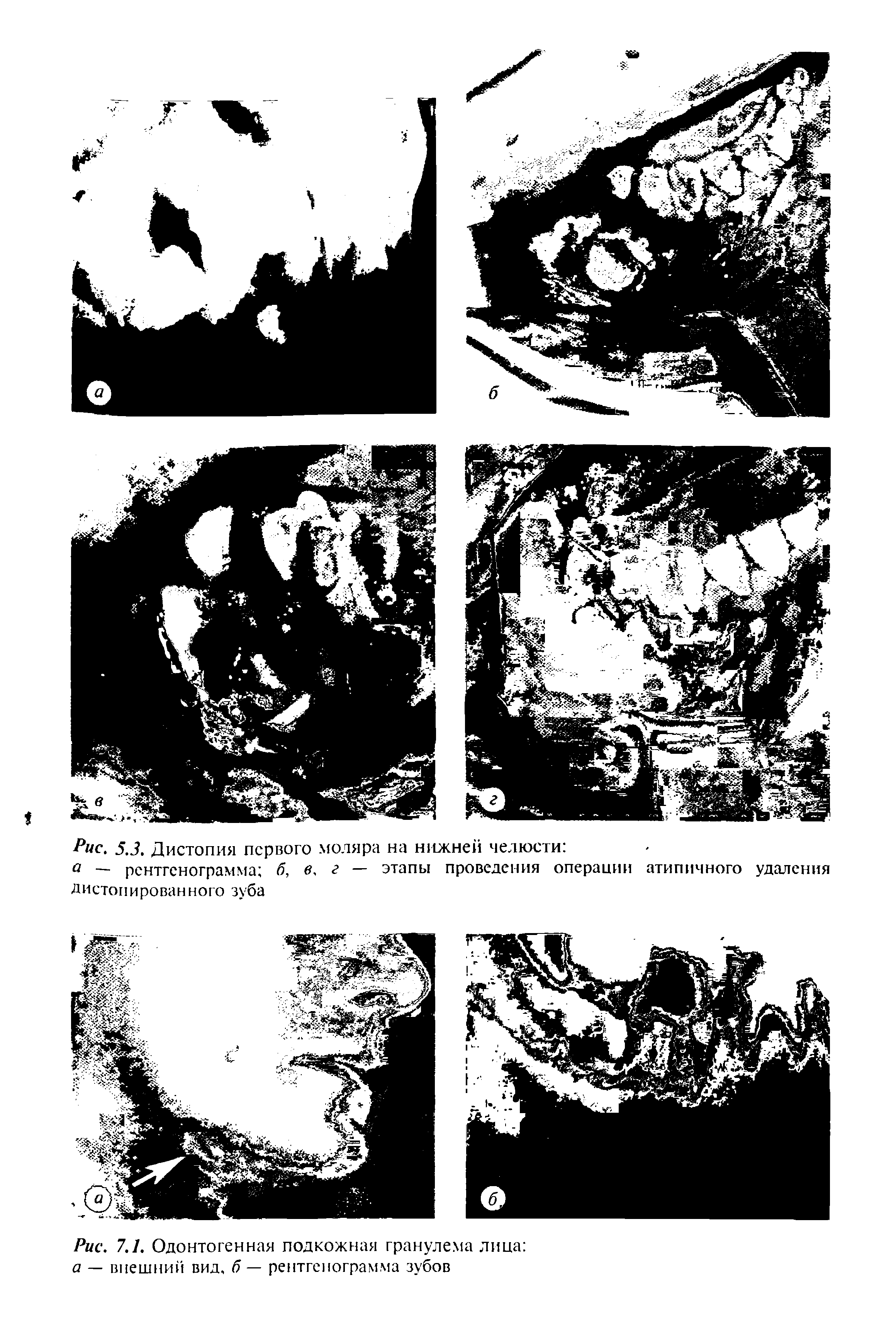 Рис. 7.1. Одонтогенная подкожная гранулема лица а — внешний вид, б — рентгенограмма зубов...