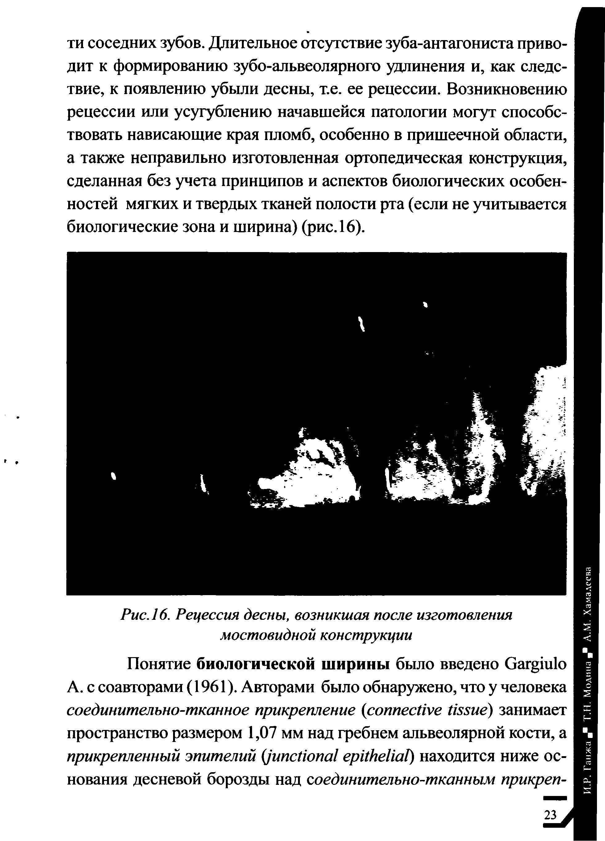 Рис. 16. Рецессия десны, возникшая после изготовления мостовидной конструкции...