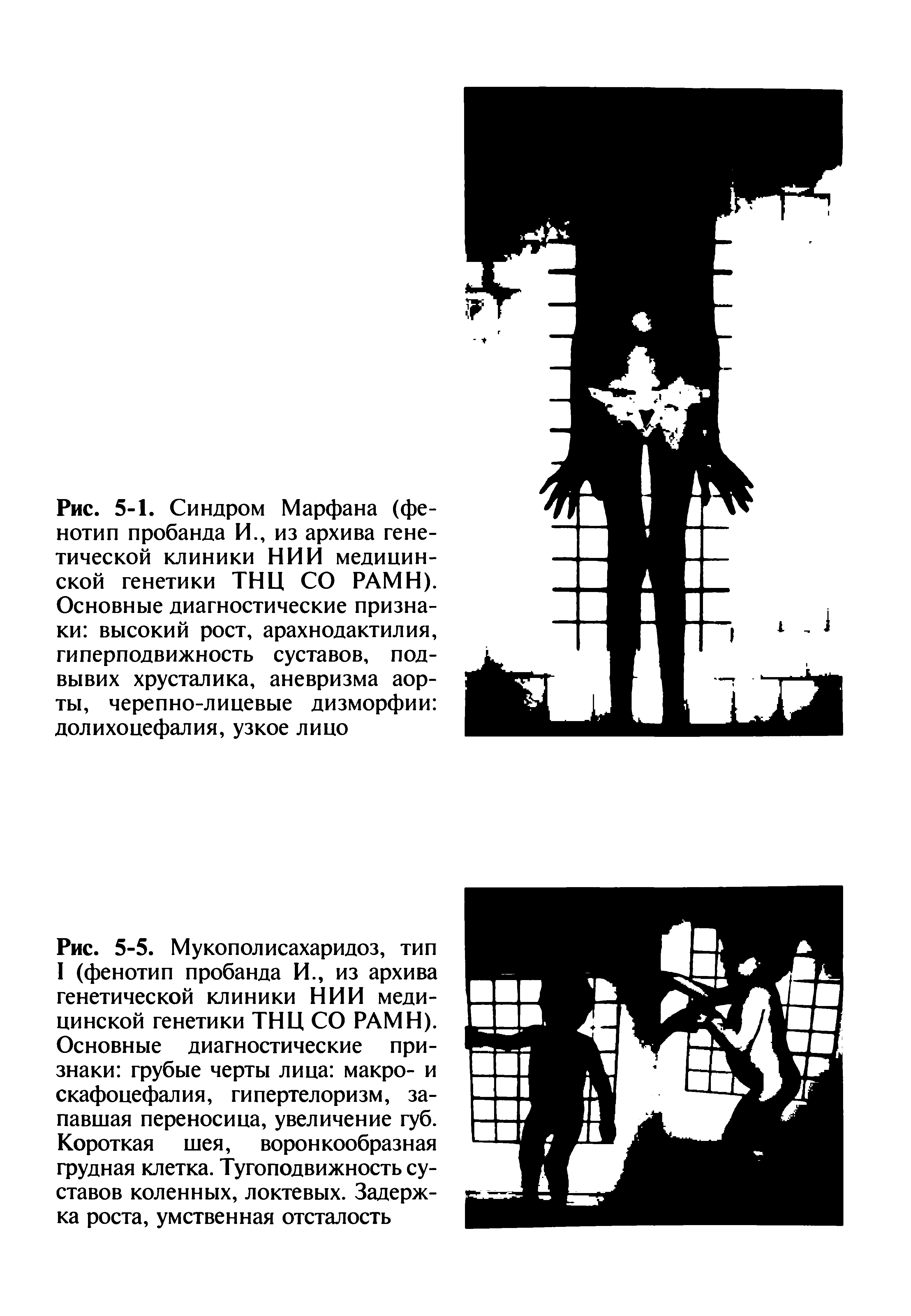 Рис. 5-5. Мукополисахаридоз, тип I (фенотип пробанда И., из архива генетической клиники НИИ медицинской генетики ТНЦ СО РАМН). Основные диагностические признаки грубые черты лица макро- и скафоцефалия, гипертелоризм, запавшая переносица, увеличение губ. Короткая шея, воронкообразная грудная клетка. Тугоподвижность суставов коленных, локтевых. Задержка роста, умственная отсталость...