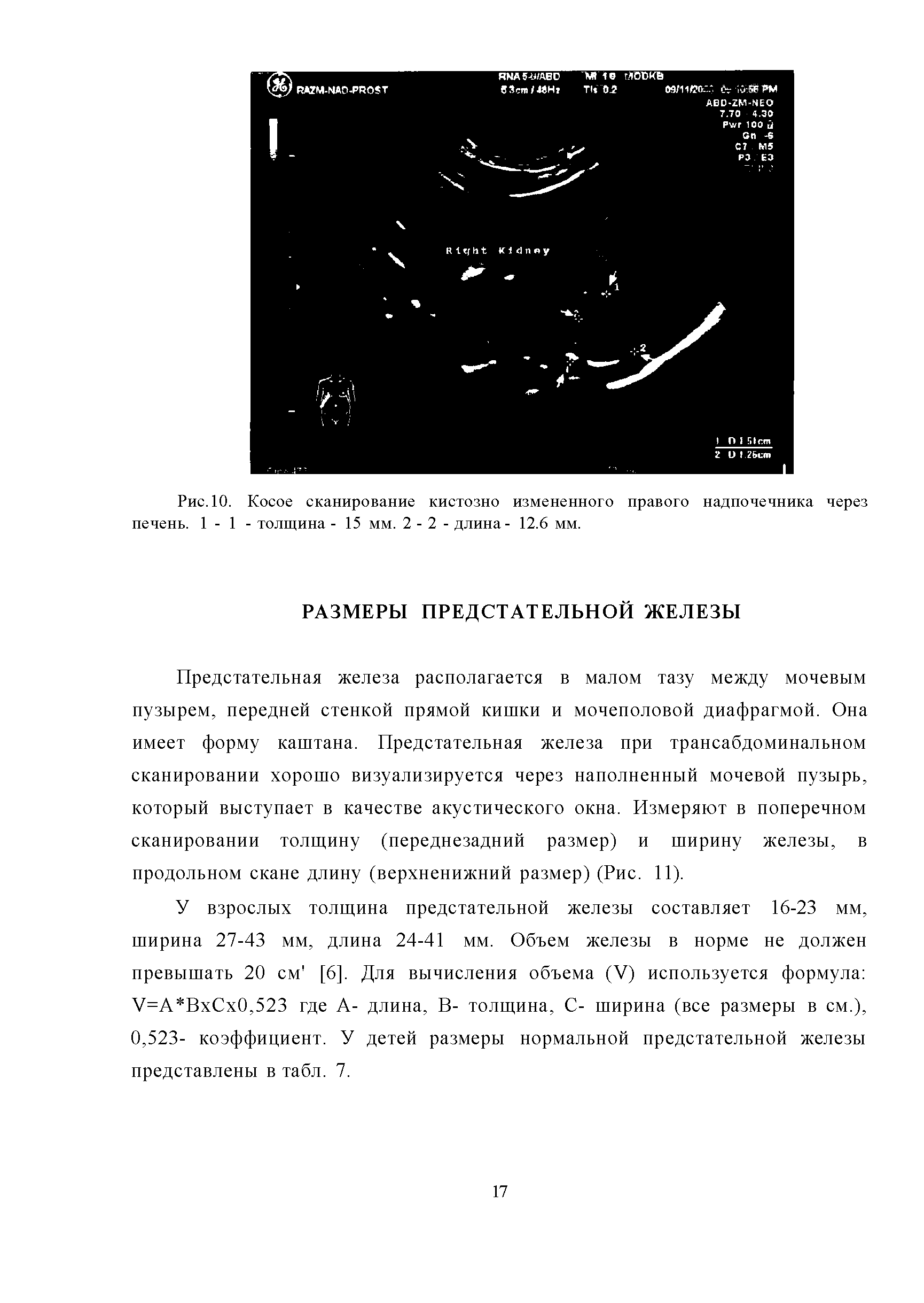 Рис. 10. Косое сканирование кистозно измененного печень. 1 - 1 - толщина - 15 мм. 2 - 2 - длина- 12.6 мм.