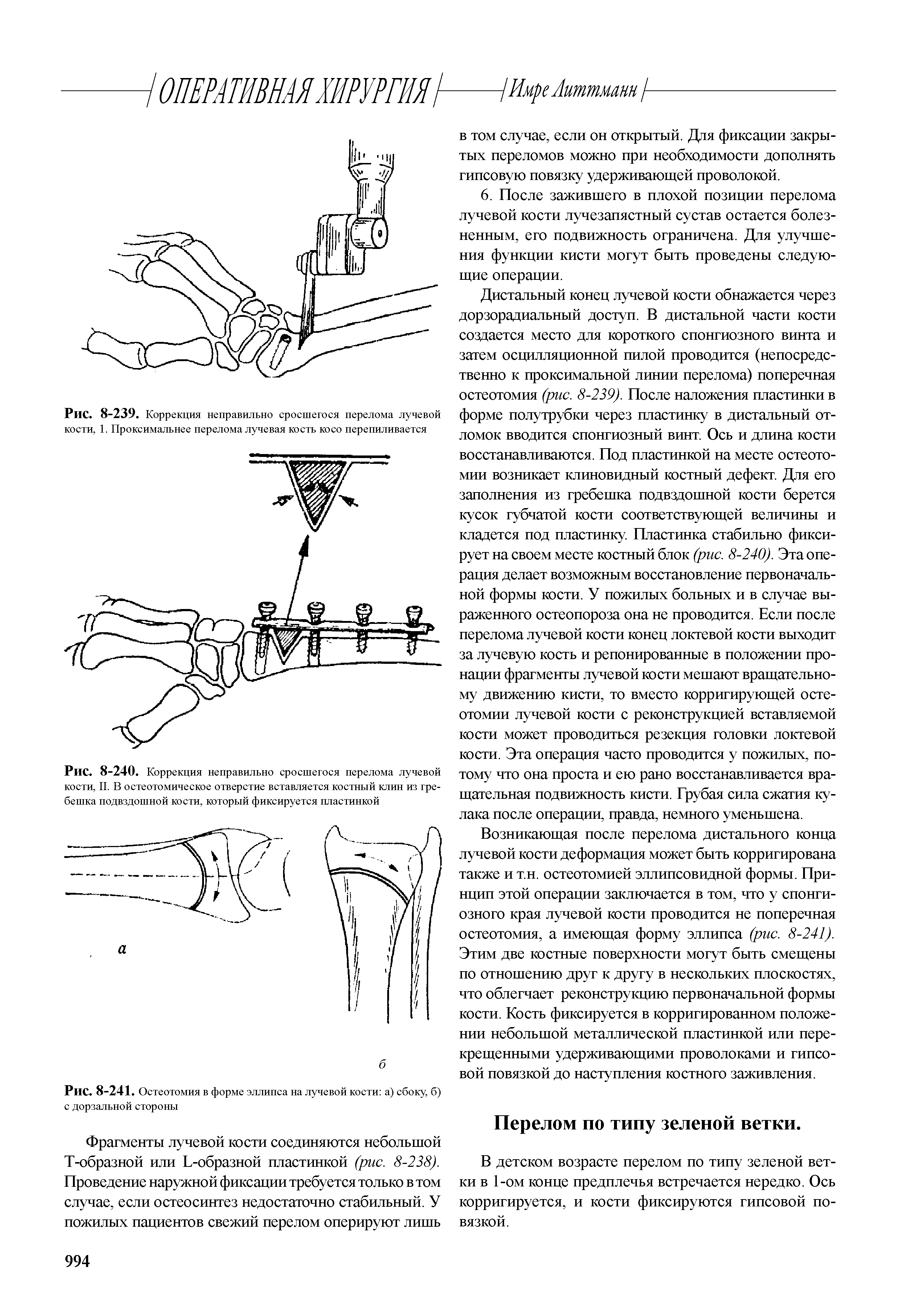 Рис. 8-239. Коррекция неправильно сросшегося перелома лучевой кости, 1. Проксимальнее перелома лучевая кость косо перепиливается...