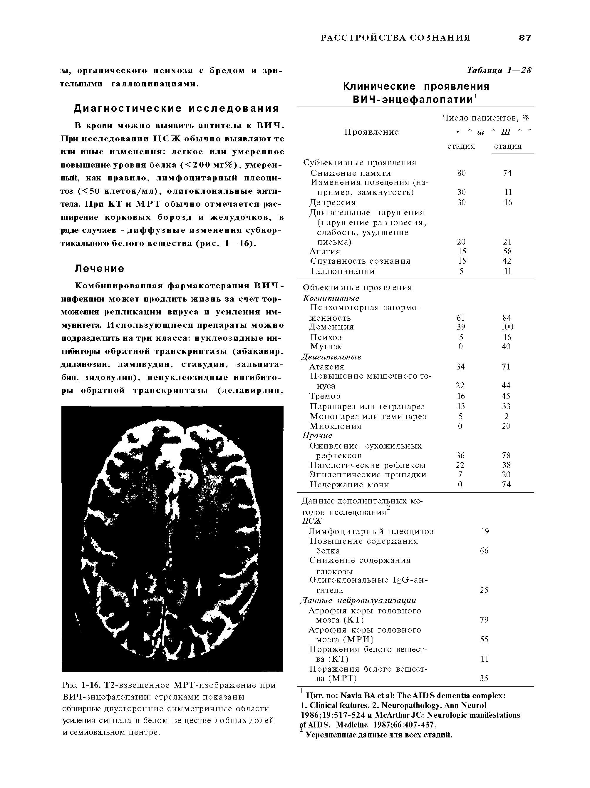 Рис. 1-16. Т2-взвешенное МРТ-изображение при ВИЧ-энцефалопатии стрелками показаны обширные двусторонние симметричные области усиления сигнала в белом веществе лобных долей и семиовальном центре.