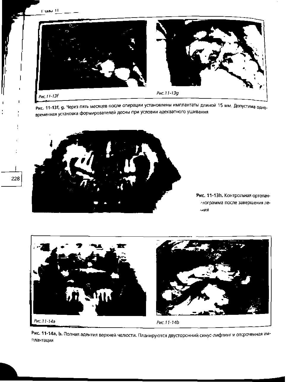 Рис. 11-14а, Ь. Полная адентия верхней челюсти. Планируются двусторонний синус-лифтинг и отсроченная имплантация...